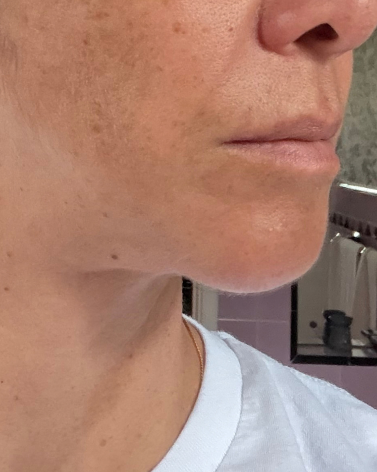 Bothered by Jowls and Nasolabial Folds, Concerned About Scars: Deep Plane Facelift Before and After at 55: Solution · After, Cheek repositioning and jawline definition