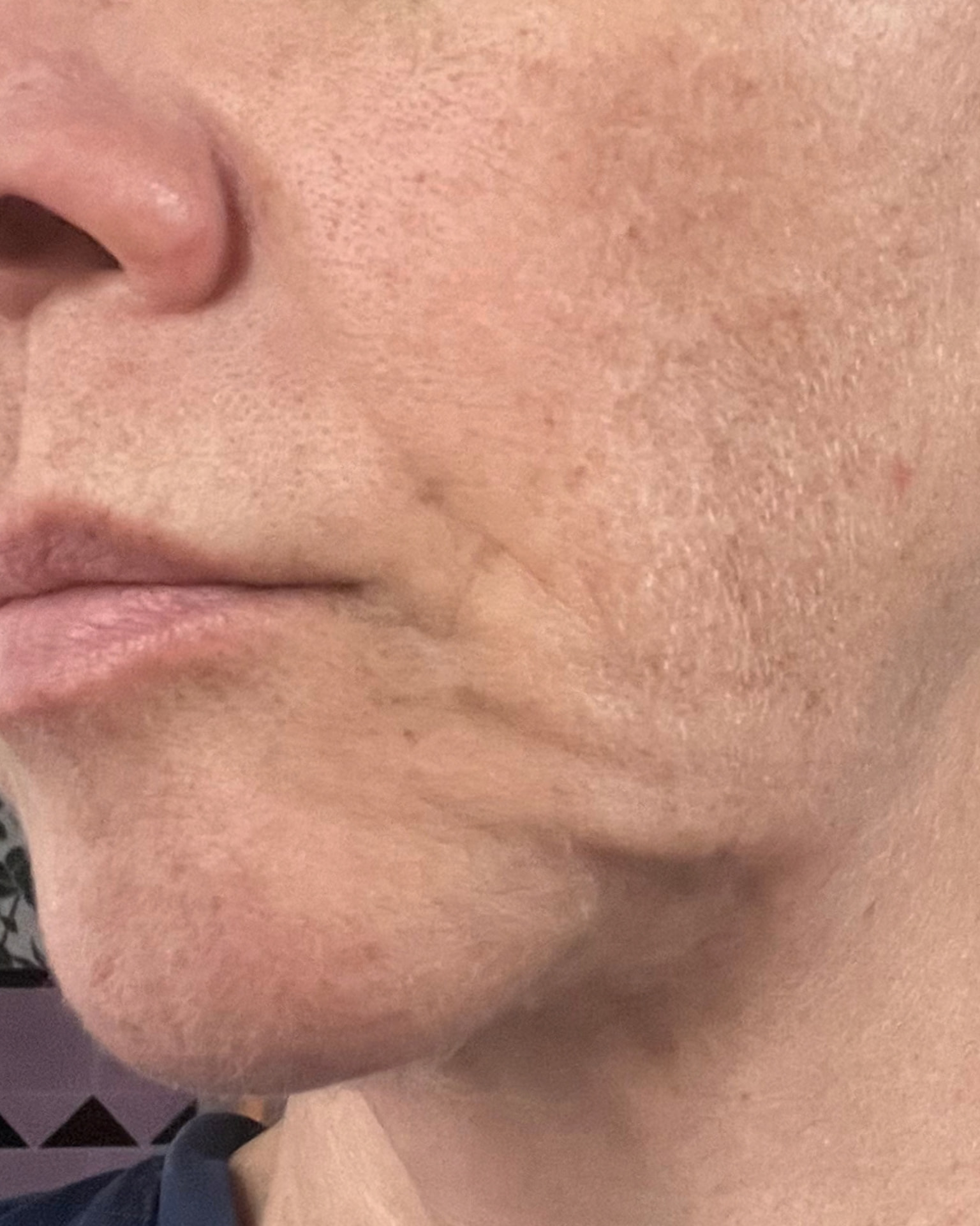 Bothered by Jowls and Nasolabial Folds, Concerned About Scars: Deep Plane Facelift Before and After at 55: Problem · Before, Deepened folds and a heavier lower face