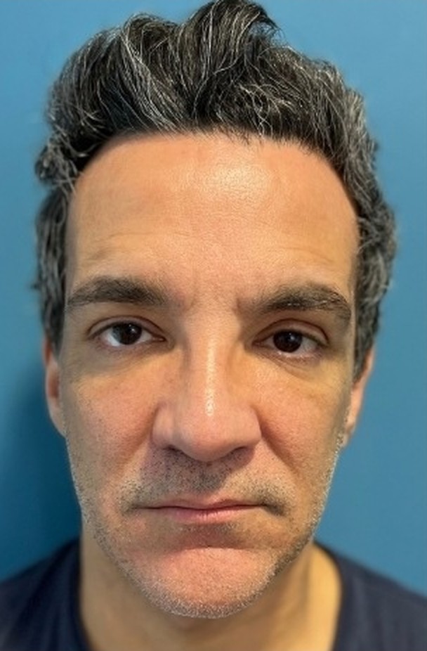 Sharper Jawline, Tighter Neck: Submental Platysmal Plication + Renuvion, Renuvion only — skin tightening without platysmal plication, view 1