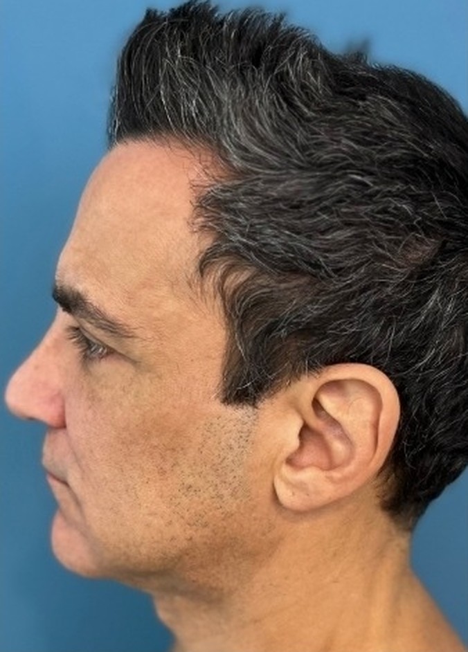 Sharper Jawline, Tighter Neck: Submental Platysmal Plication + Renuvion, Baseline neck and jawline prior to treatment, view 2