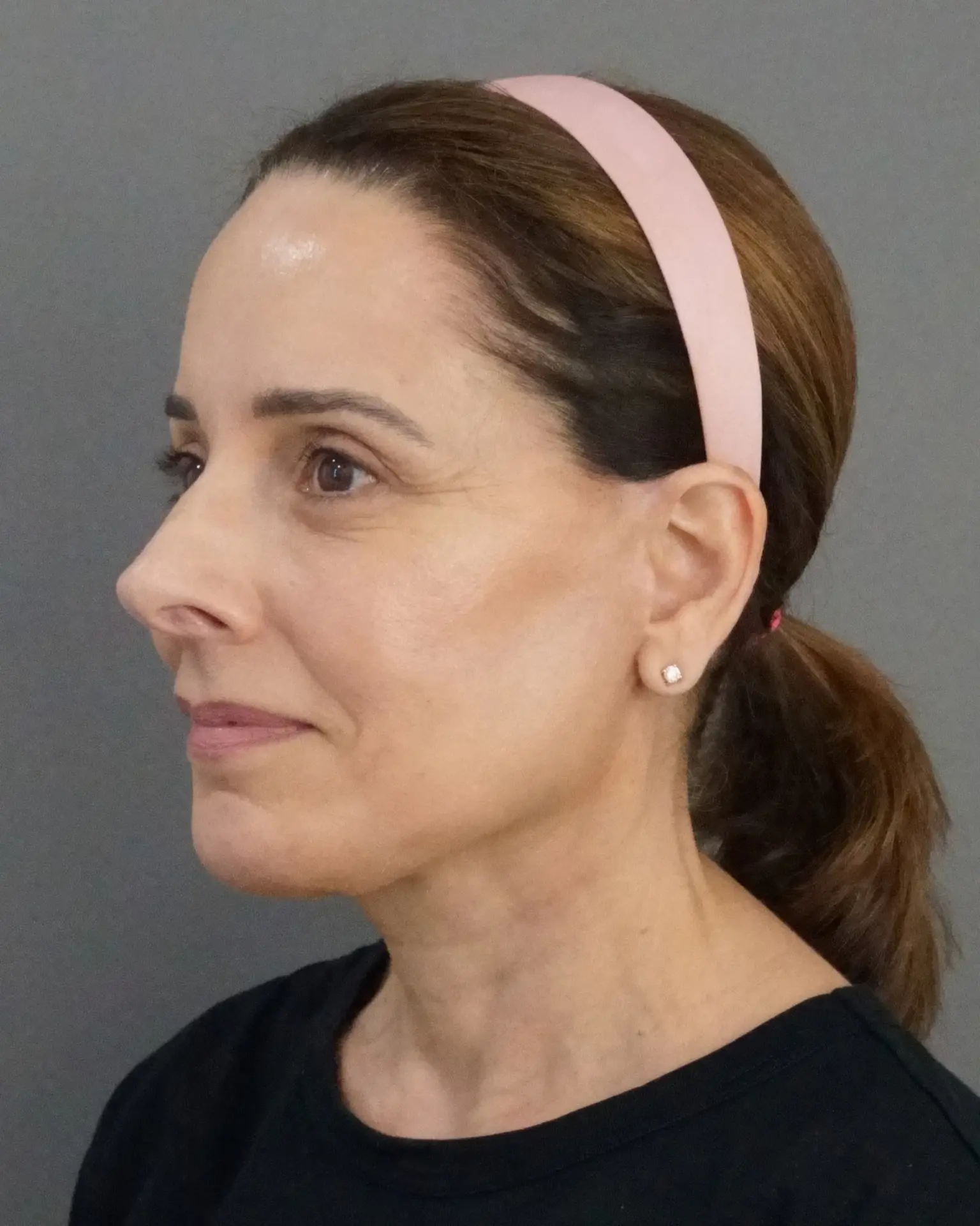 Deep Plane Facelift at 61: Upper, Mid & Lower Lift with Blepharoplasty — Before and After, after, view 2