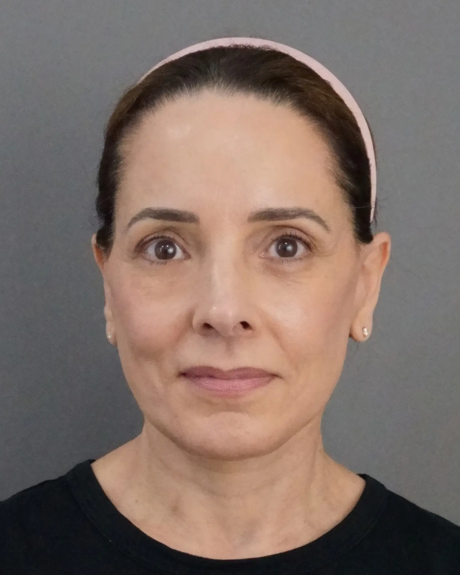 Deep Plane Facelift at 61: Upper, Mid & Lower Lift with Blepharoplasty — Before and After, after, view 1