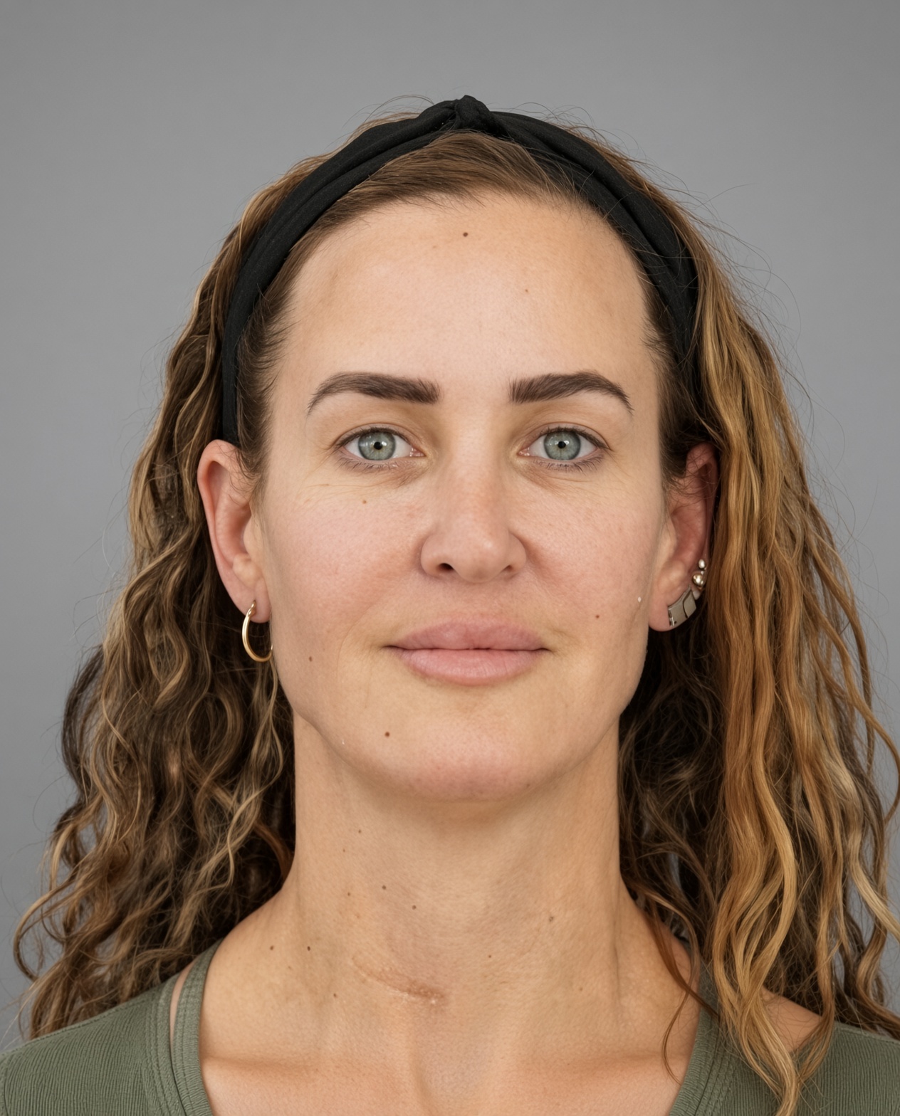 50 Year Old END of Aging Facelift by Dr. Suzanne Trott: Endoscopic Deep Plane Results at 3 Months, before, view 1
