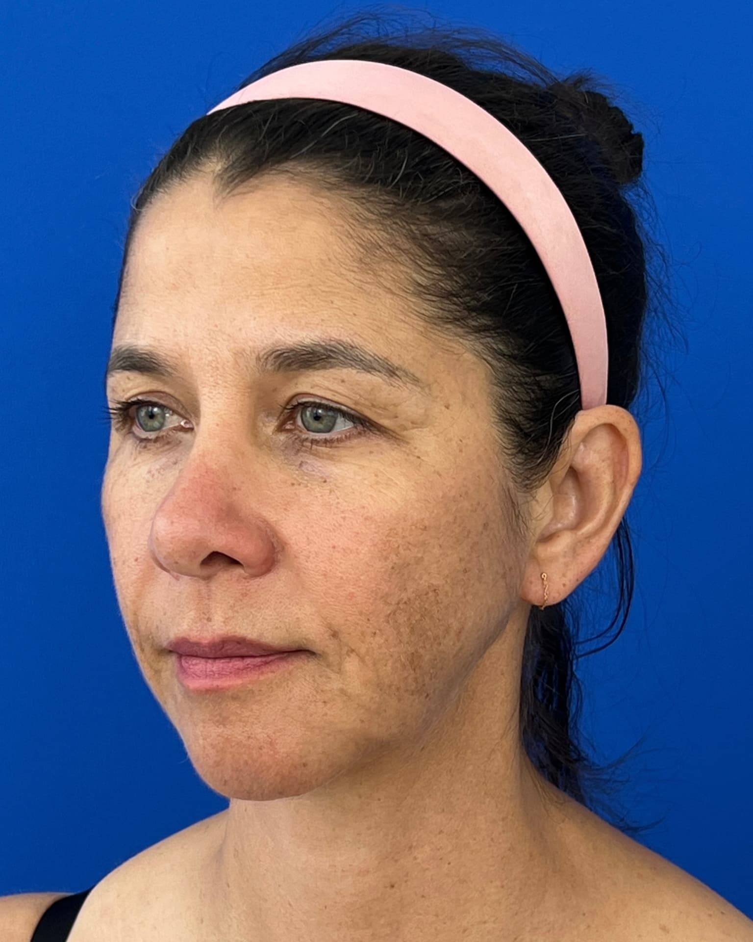 Bothered by Jowls and Nasolabial Folds, Concerned About Scars: Deep Plane Facelift Before and After at 55, before, view 2