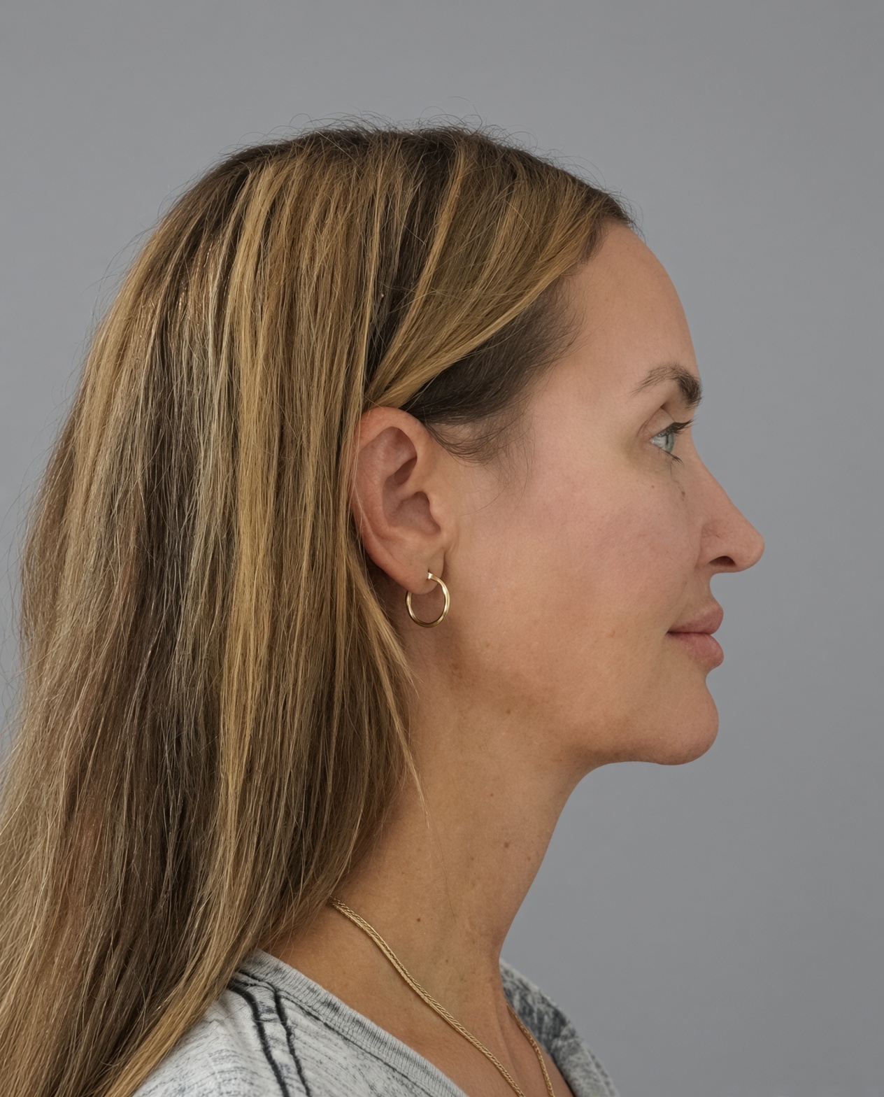 50 Year Old END of Aging Facelift by Dr. Suzanne Trott: Endoscopic Deep Plane Results at 3 Months, after, view 3