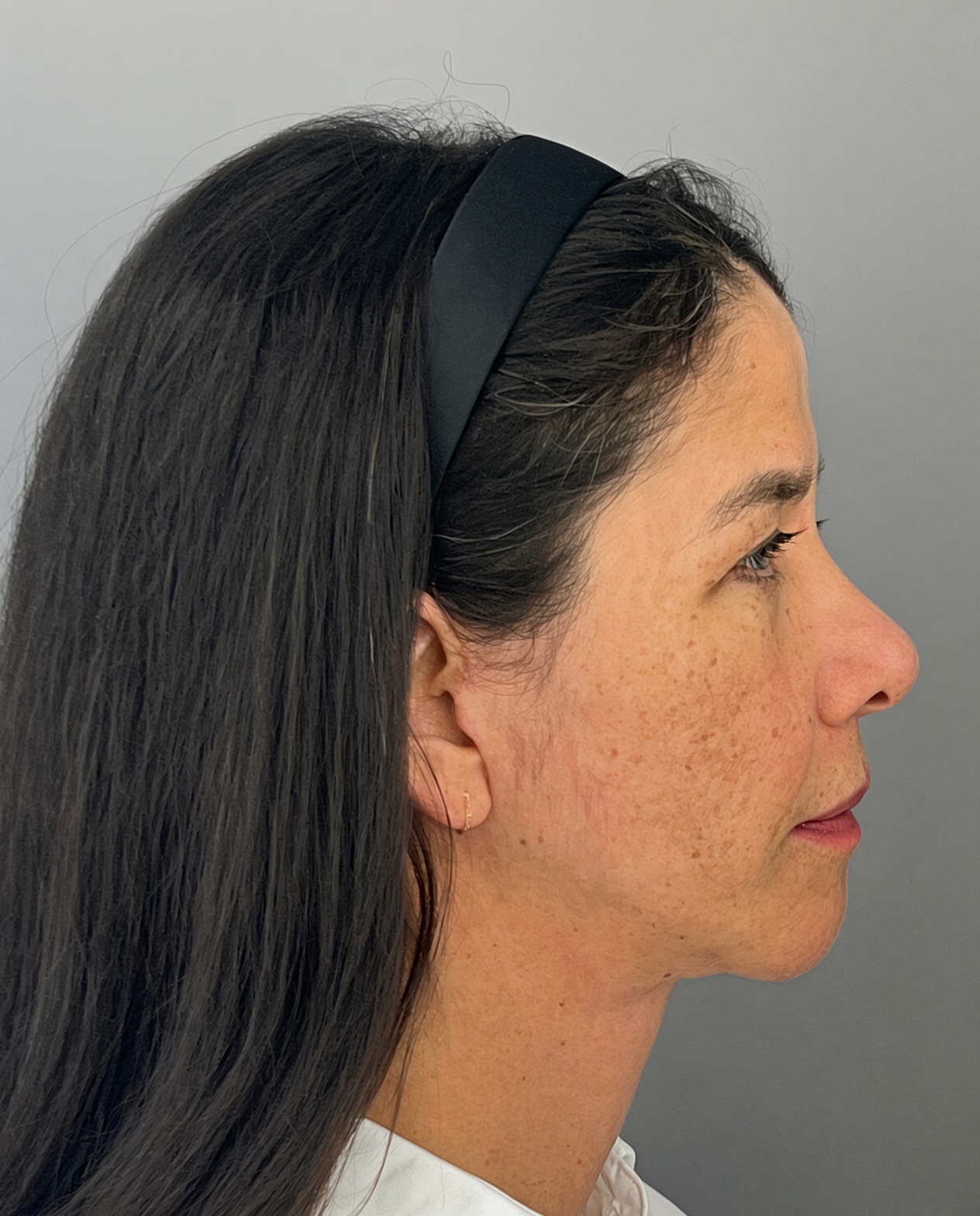 Bothered by Jowls and Nasolabial Folds, Concerned About Scars: Deep Plane Facelift Before and After at 55, after, view 5