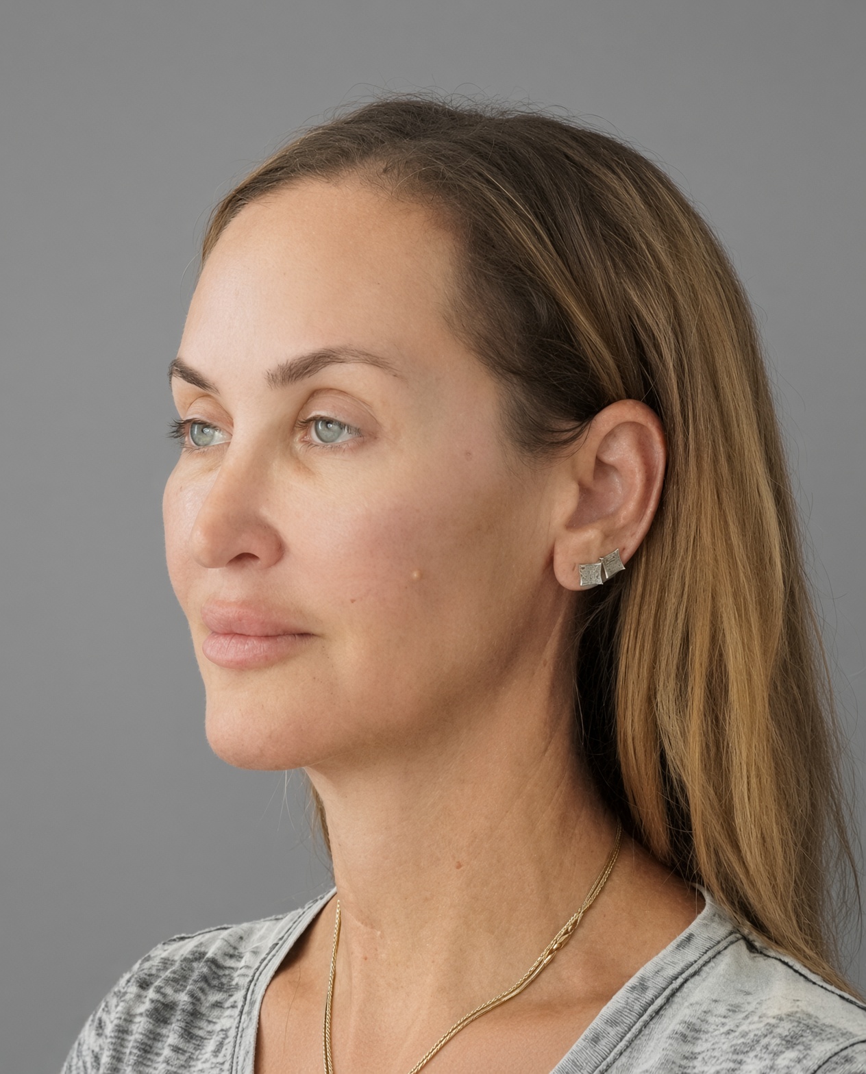 50 Year Old END of Aging Facelift by Dr. Suzanne Trott: Endoscopic Deep Plane Results at 3 Months, after, view 4
