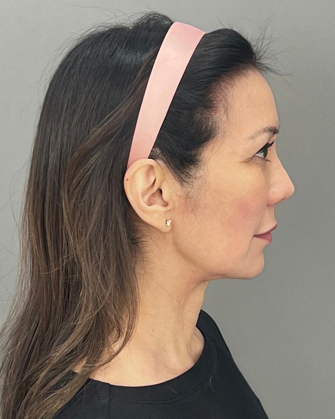 Jawline Contouring Over Time: Submental Platysmal Plication, Then a Lower Facelift and Neck Lift, Before the facelift, ten years after the plication, view 1
