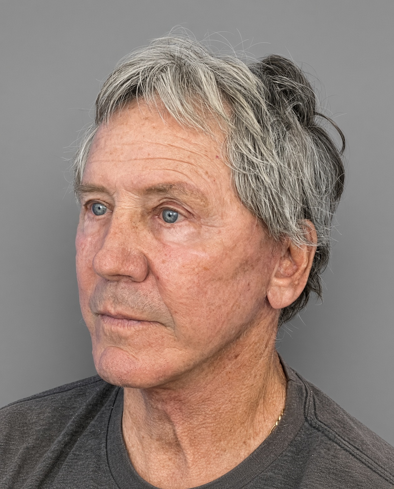 Worried About Keeping His Masculine Look: Natural Male Deep Plane Facelift, Neck Lift, Upper Blepharoplasty & CO₂ Laser Before and After at 73, after, view 2