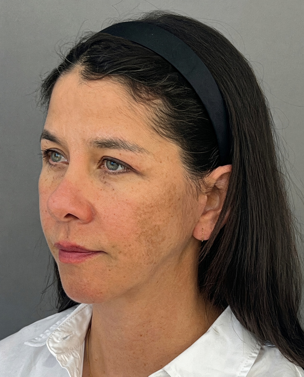 Bothered by Jowls and Nasolabial Folds, Concerned About Scars: Deep Plane Facelift Before and After at 55, after, view 2