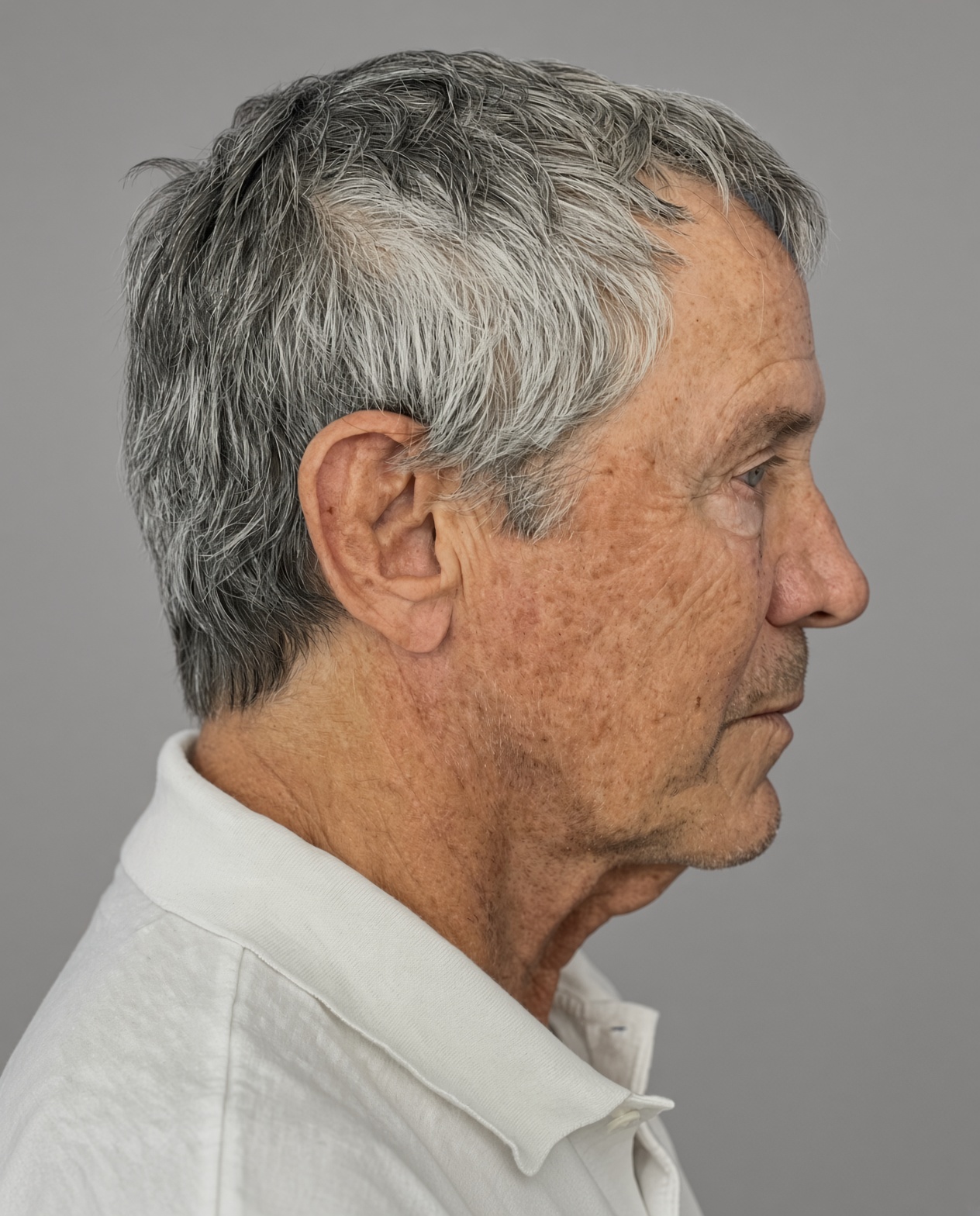 Worried About Keeping His Masculine Look: Natural Male Deep Plane Facelift, Neck Lift, Upper Blepharoplasty & CO₂ Laser Before and After at 73, before, view 5