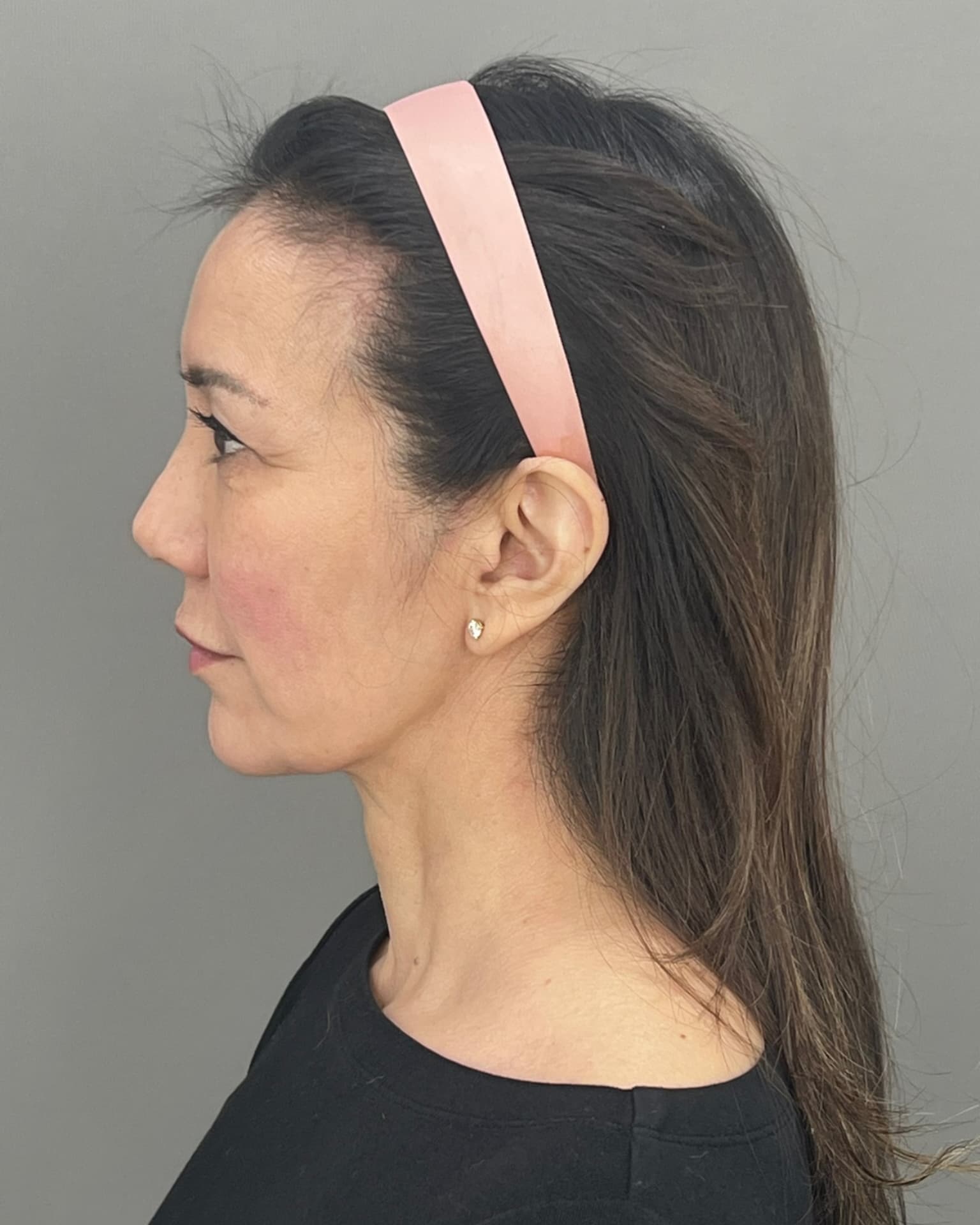 Facelift and Neck Lift at 60: Why Dr. Trott Started With the Neck, before, view 3