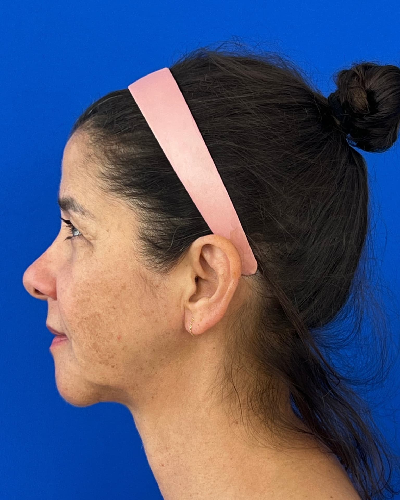 Bothered by Jowls and Nasolabial Folds, Concerned About Scars: Deep Plane Facelift Before and After at 55, before, view 3