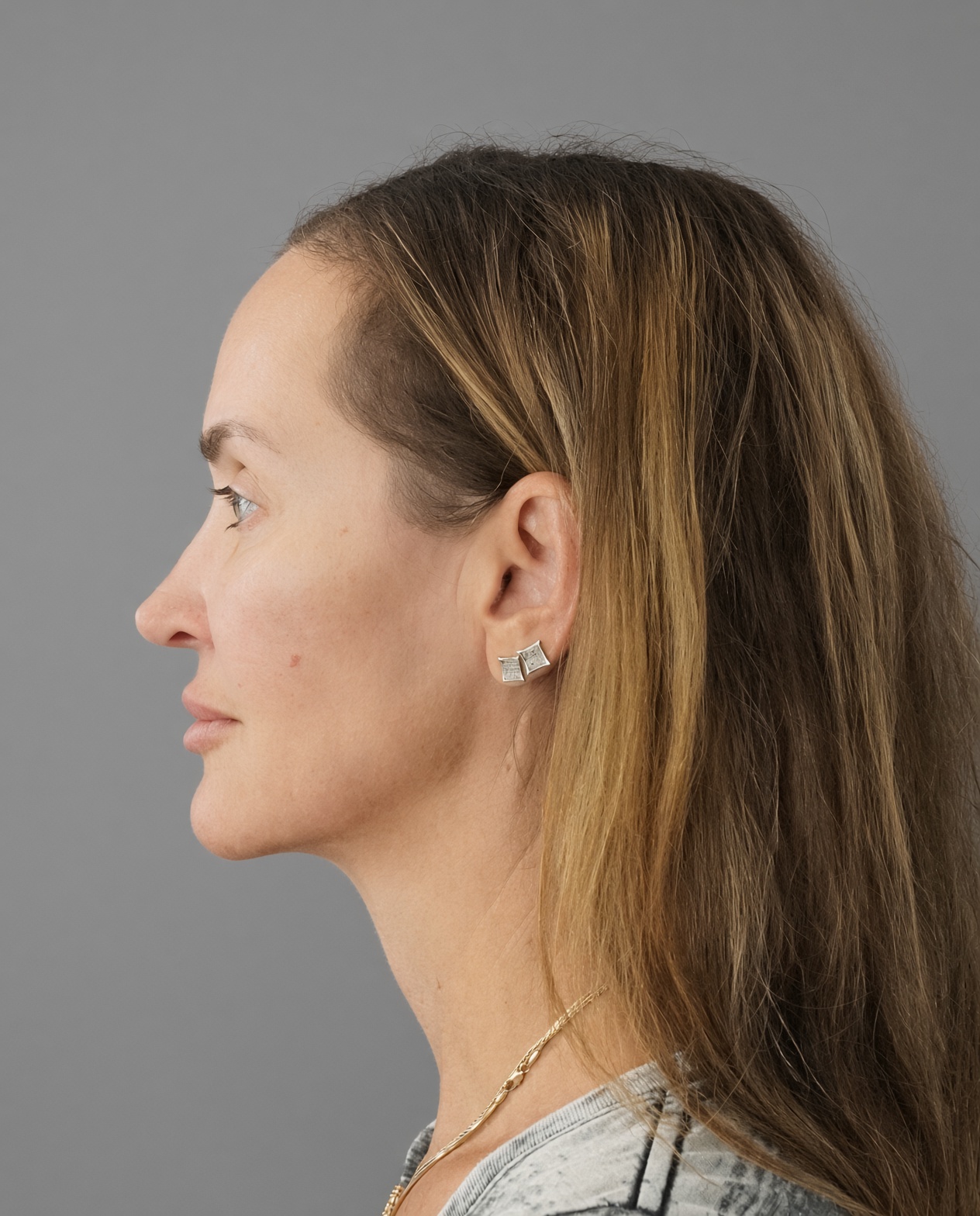 50 Year Old END of Aging Facelift by Dr. Suzanne Trott: Endoscopic Deep Plane Results at 3 Months, after, view 5