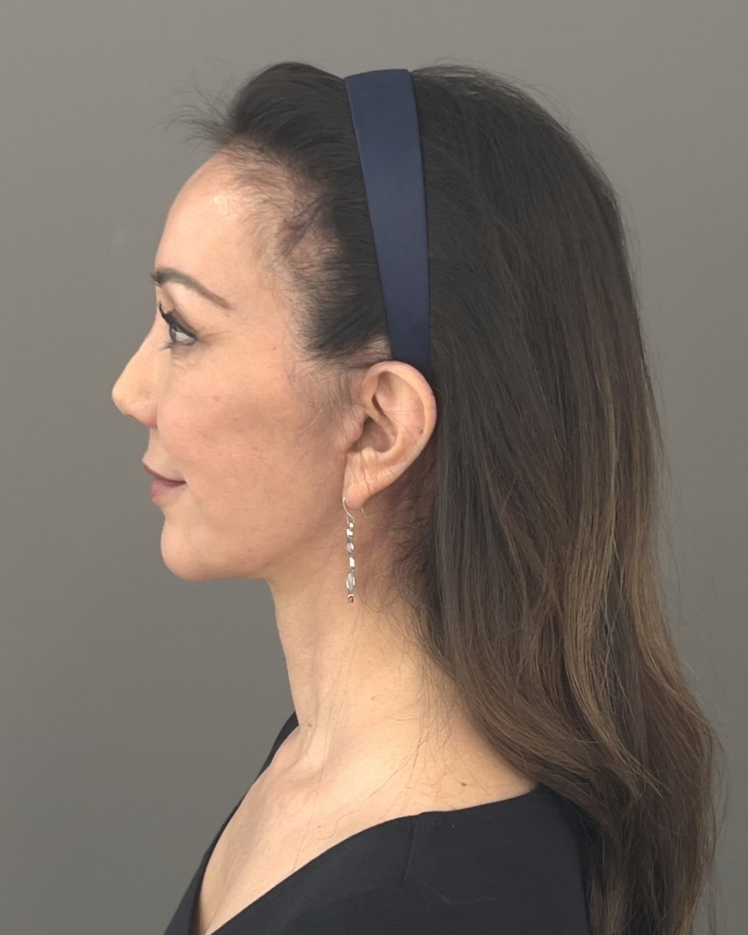 Facelift and Neck Lift at 60: Why Dr. Trott Started With the Neck, after, view 3
