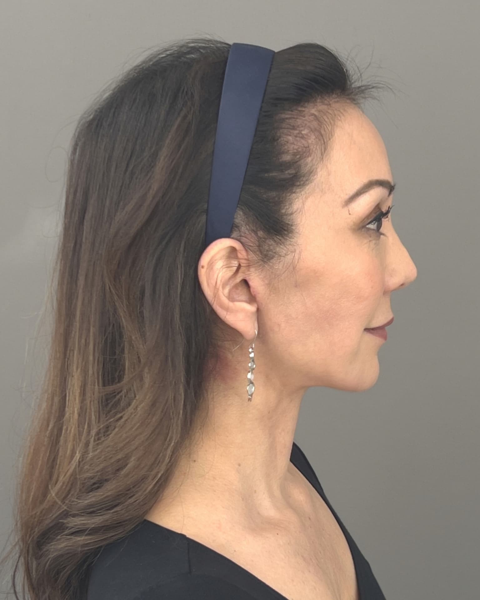 Facelift and Neck Lift at 60: Why Dr. Trott Started With the Neck, after, view 5