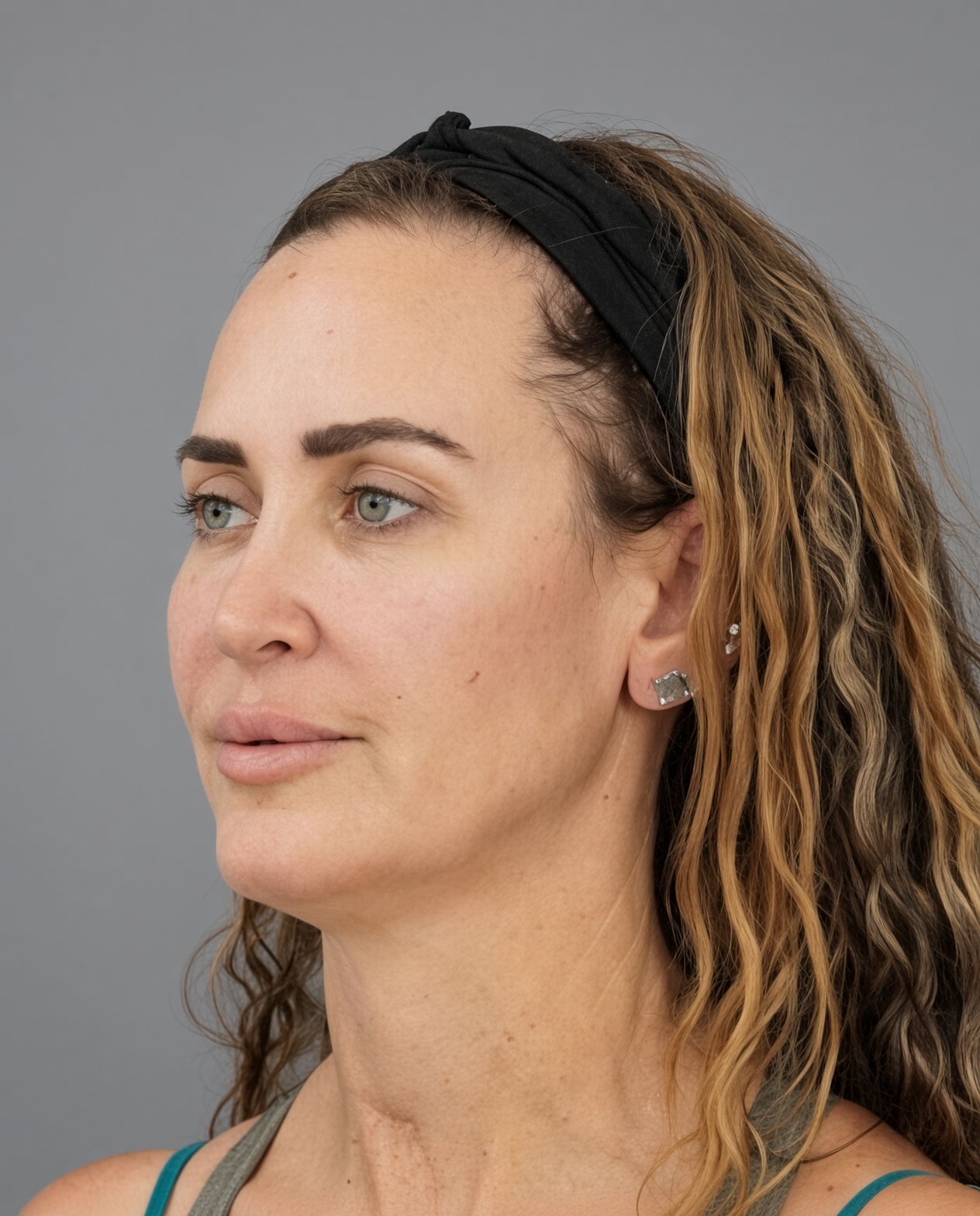 50 Year Old END of Aging Facelift by Dr. Suzanne Trott: Endoscopic Deep Plane Results at 3 Months, before, view 4