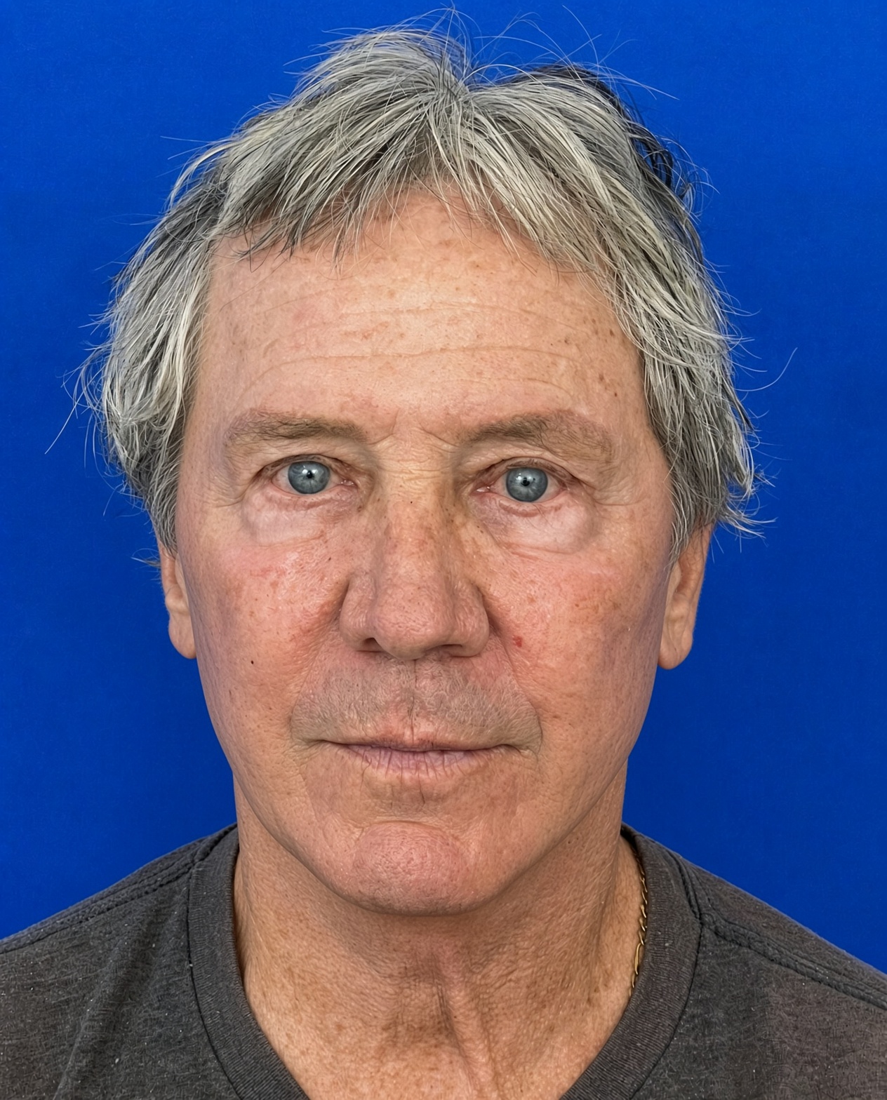 Worried About Keeping His Masculine Look: Natural Male Deep Plane Facelift, Neck Lift, Upper Blepharoplasty & CO₂ Laser Before and After at 72, after, view 1