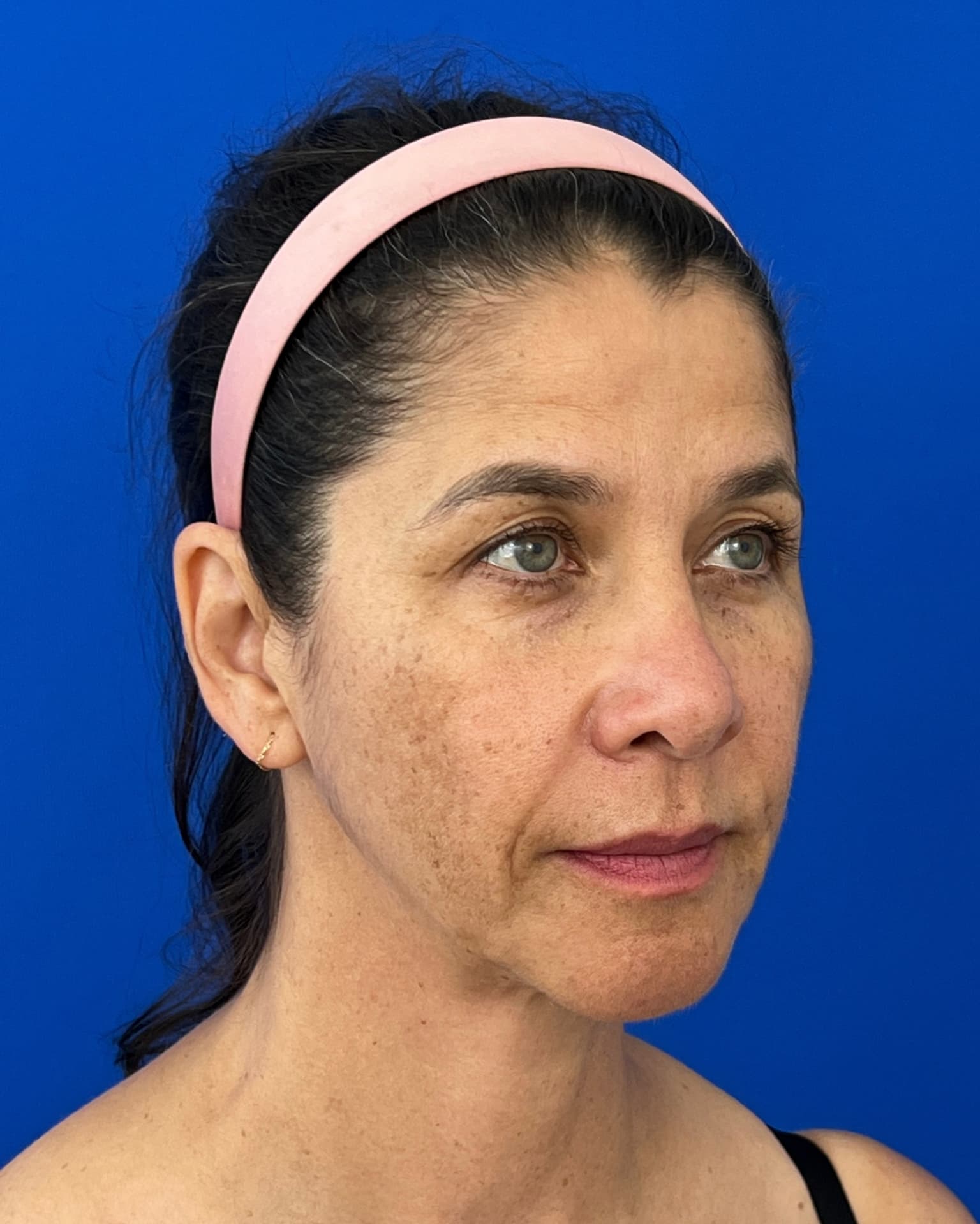Bothered by Jowls and Nasolabial Folds, Concerned About Scars: Deep Plane Facelift Before and After at 55, before, view 4
