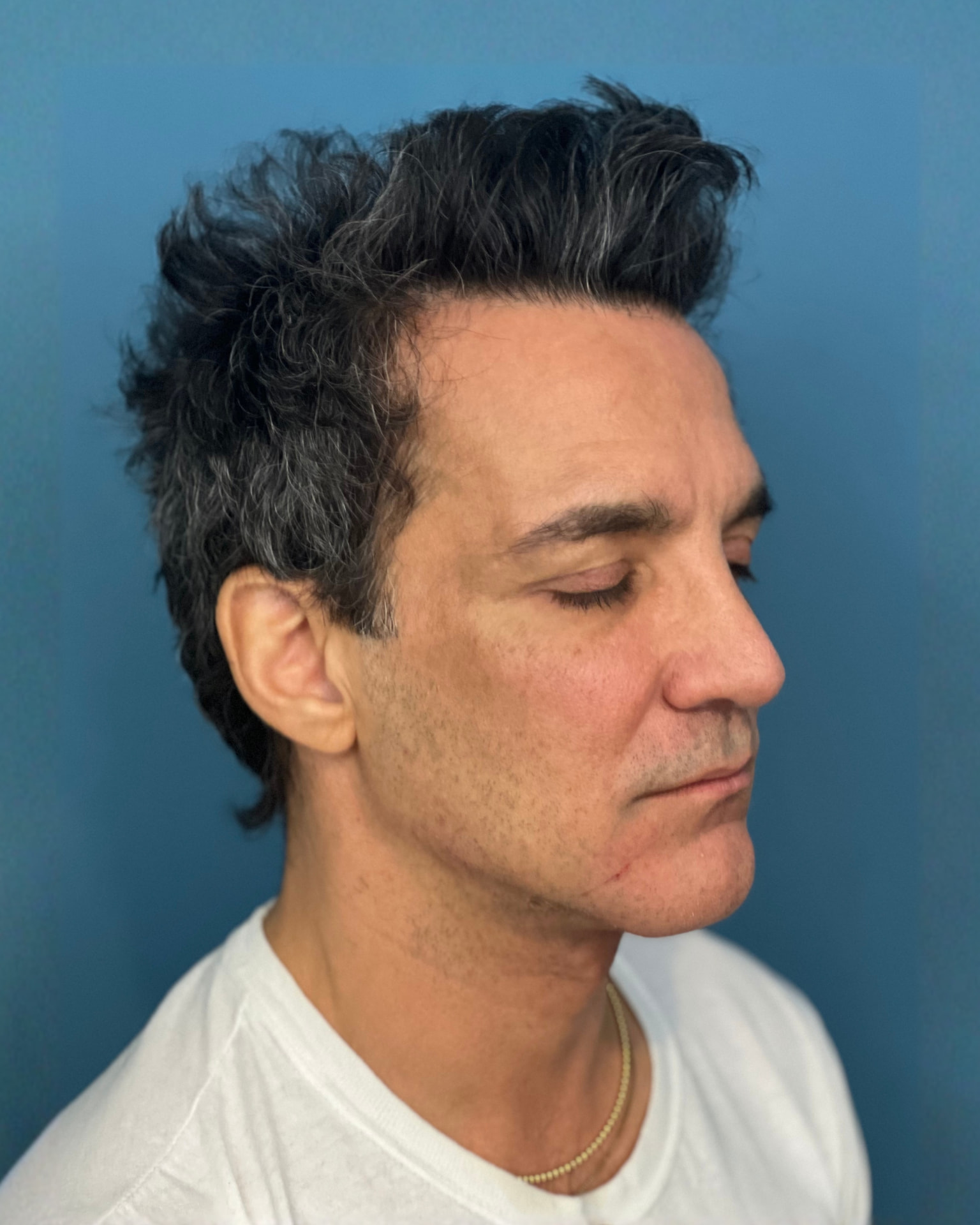 Sharper Jawline, Tighter Neck: Submental Platysmal Plication + Renuvion