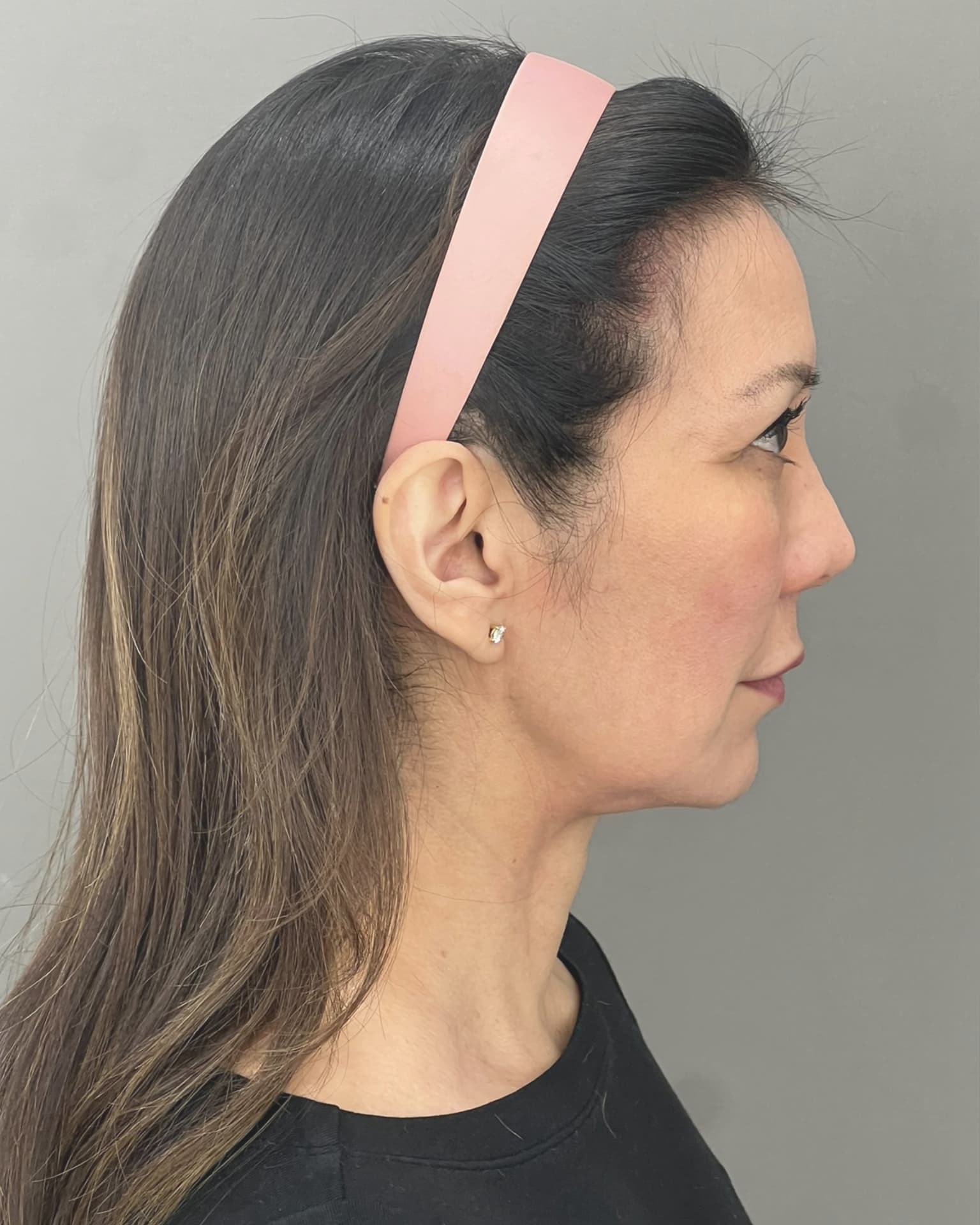 Facelift and Neck Lift at 60: Why Dr. Trott Started With the Neck, before, view 5