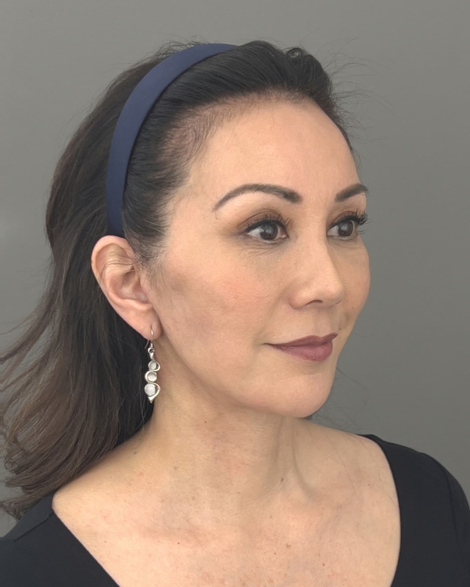 Facelift and Neck Lift at 60: Why Dr. Trott Started With the Neck, after, view 4