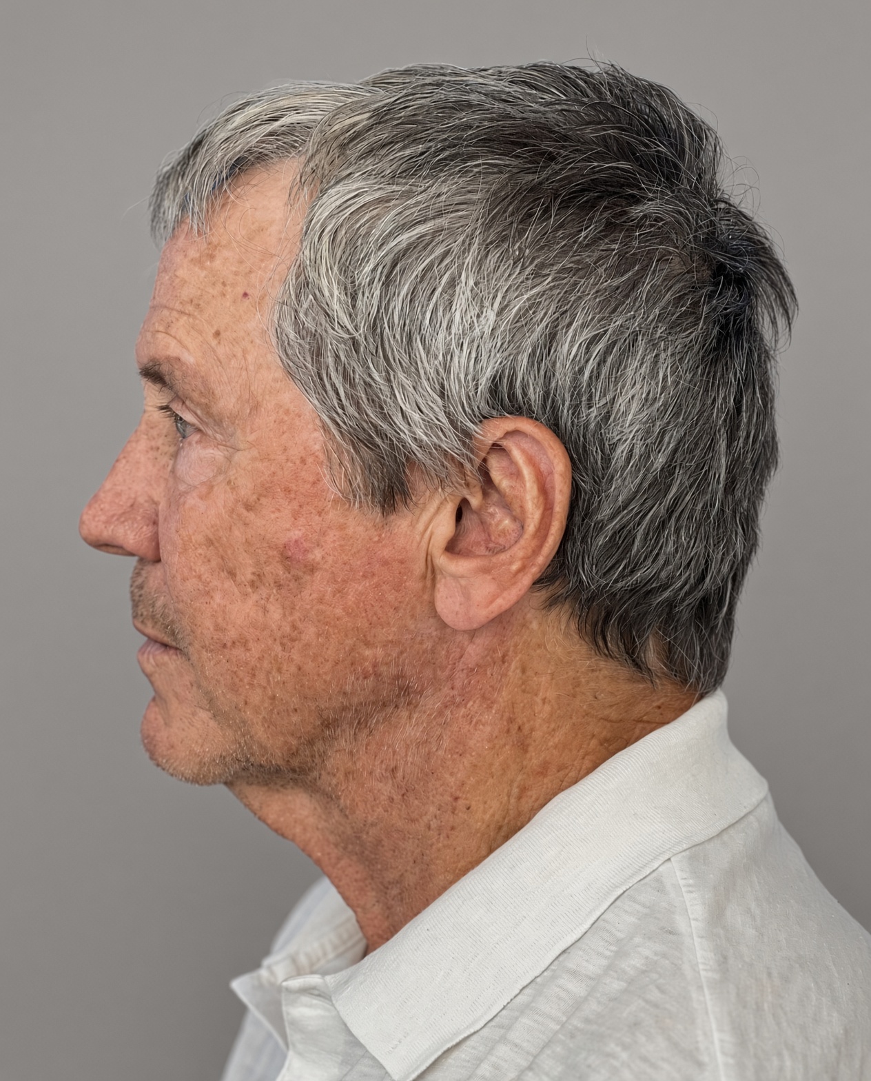 Worried About Keeping His Masculine Look: Natural Male Deep Plane Facelift, Neck Lift, Upper Blepharoplasty & CO₂ Laser Before and After at 73, before, view 3