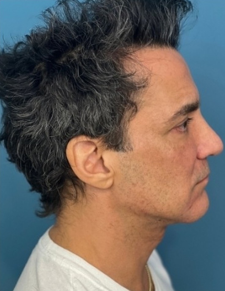 Sharper Jawline, Tighter Neck: Submental Platysmal Plication + Renuvion, Renuvion with platysmal plication, view 5
