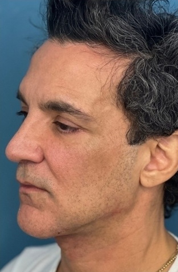 Sharper Jawline, Tighter Neck: Submental Platysmal Plication + Renuvion, Renuvion with platysmal plication, view 3