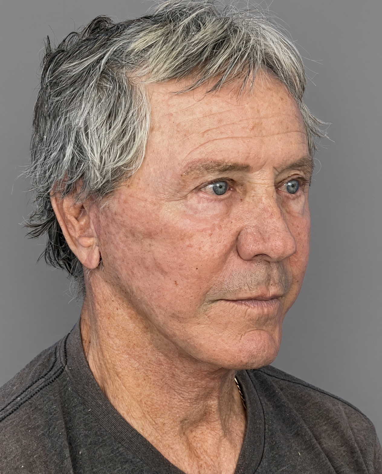 Worried About Keeping His Masculine Look: Natural Male Deep Plane Facelift, Neck Lift, Upper Blepharoplasty & CO₂ Laser Before and After at 73, after, view 4