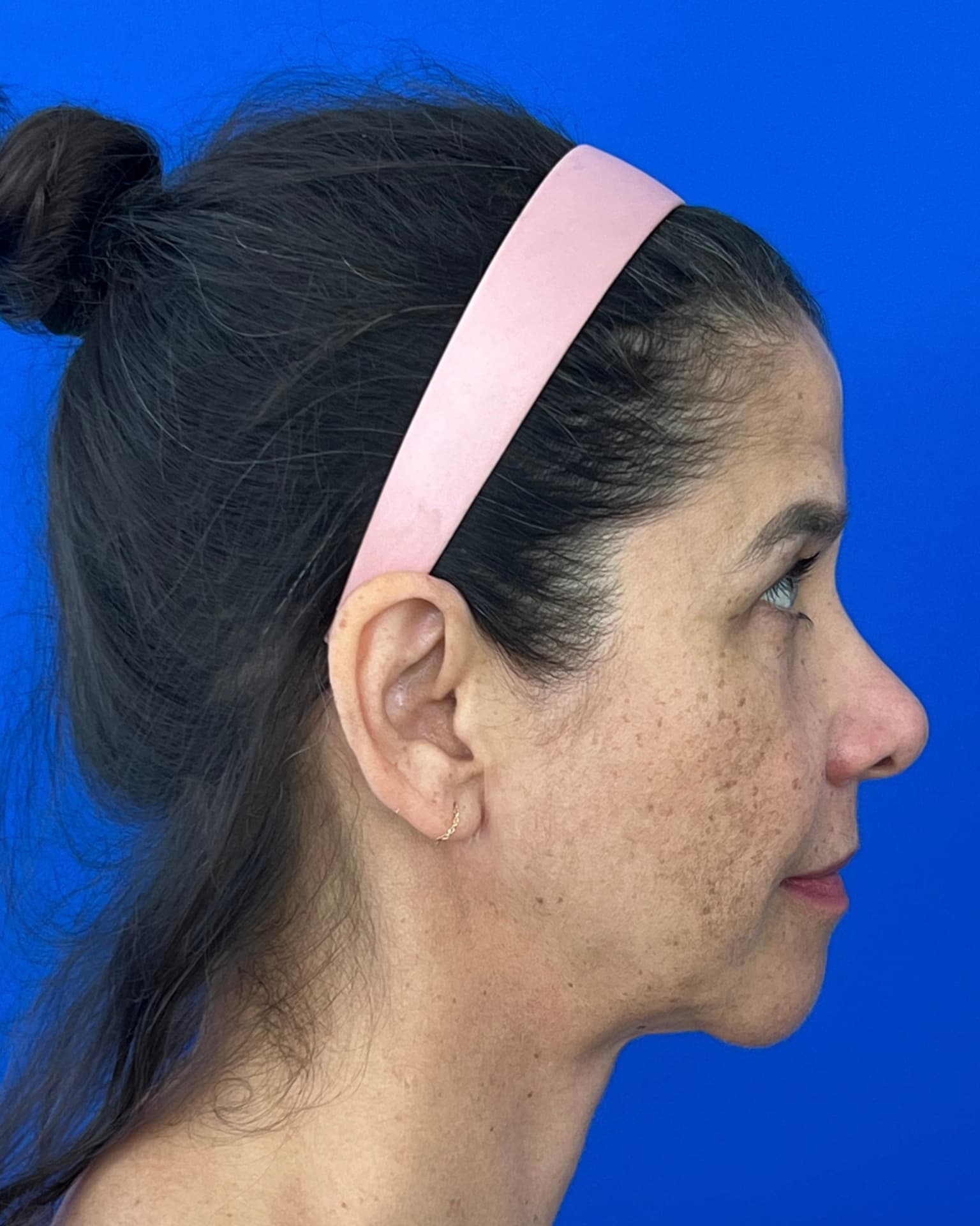 Bothered by Jowls and Nasolabial Folds, Concerned About Scars: Deep Plane Facelift Before and After at 55, before, view 5