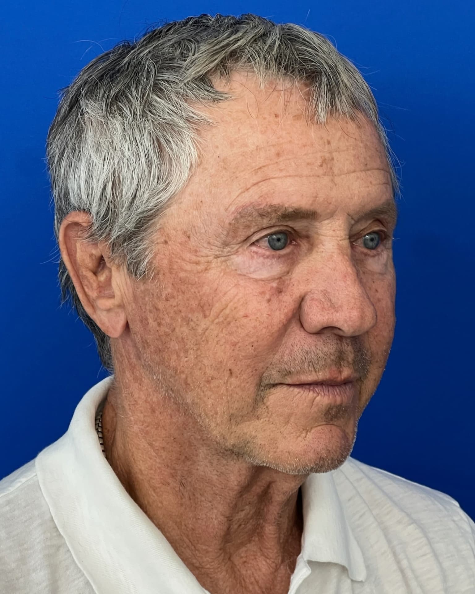 Worried About Keeping His Masculine Look: Natural Male Deep Plane Facelift, Neck Lift, Upper Blepharoplasty & CO₂ Laser Before and After at 72, before, view 4