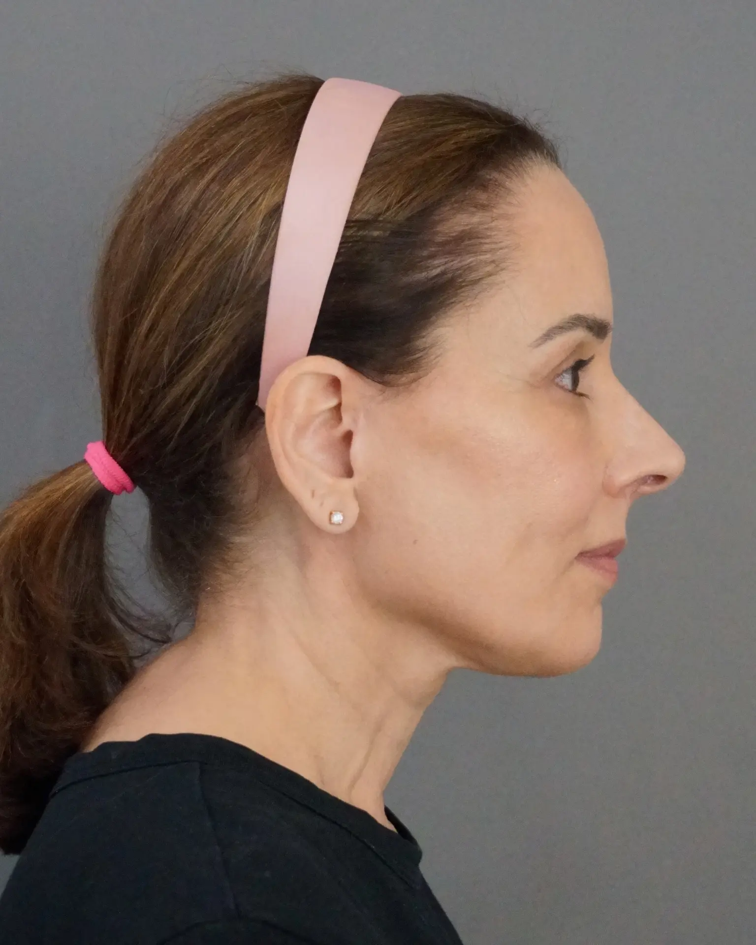 Deep Plane Facelift at 61: Upper, Mid & Lower Lift with Blepharoplasty — Before and After, after, view 5
