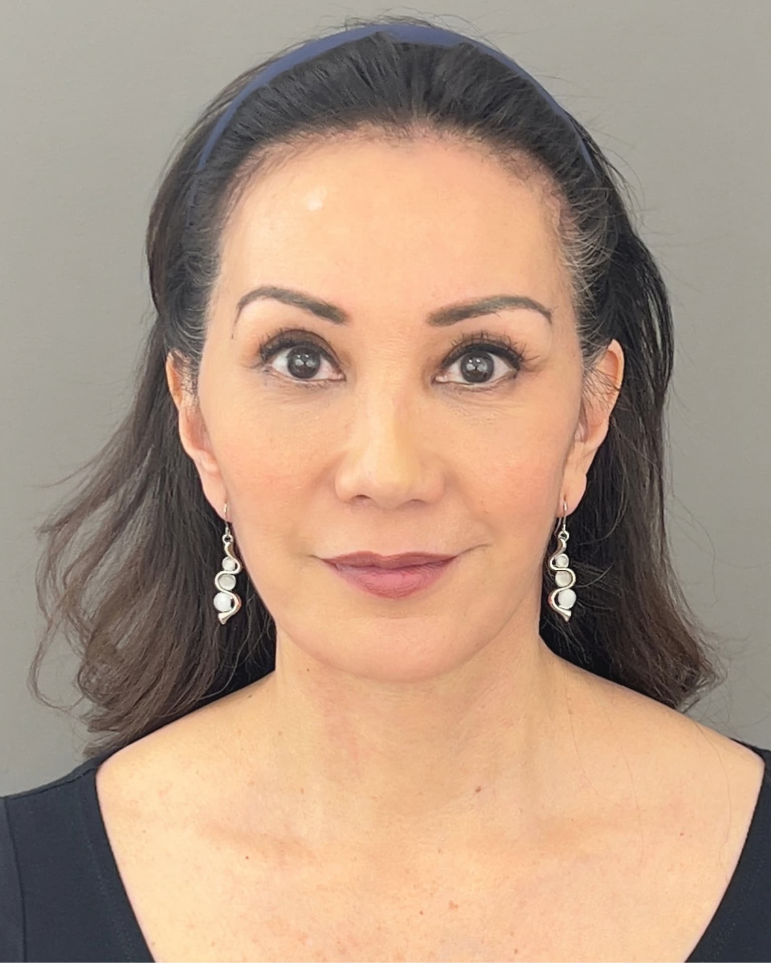 Facelift and Neck Lift at 60: Why Dr. Trott Started With the Neck, after, view 1