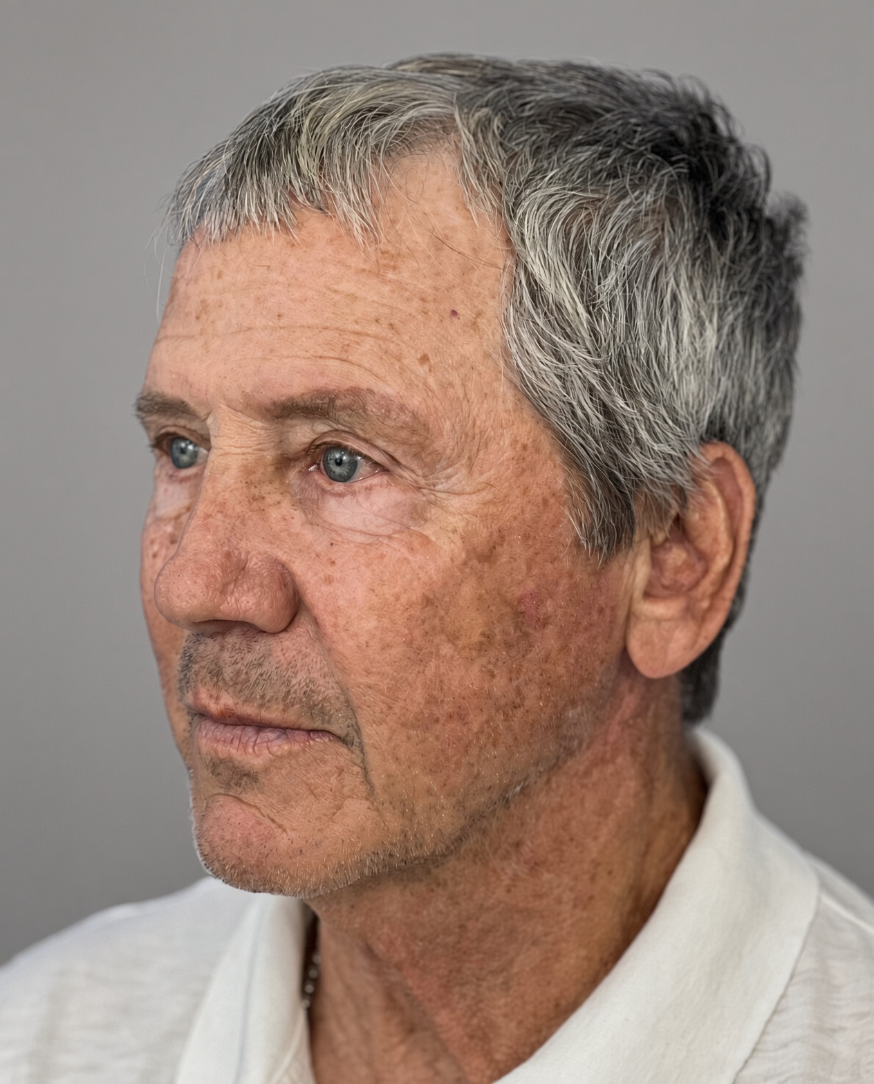 Worried About Keeping His Masculine Look: Natural Male Deep Plane Facelift, Neck Lift, Upper Blepharoplasty & CO₂ Laser Before and After at 73, before, view 2