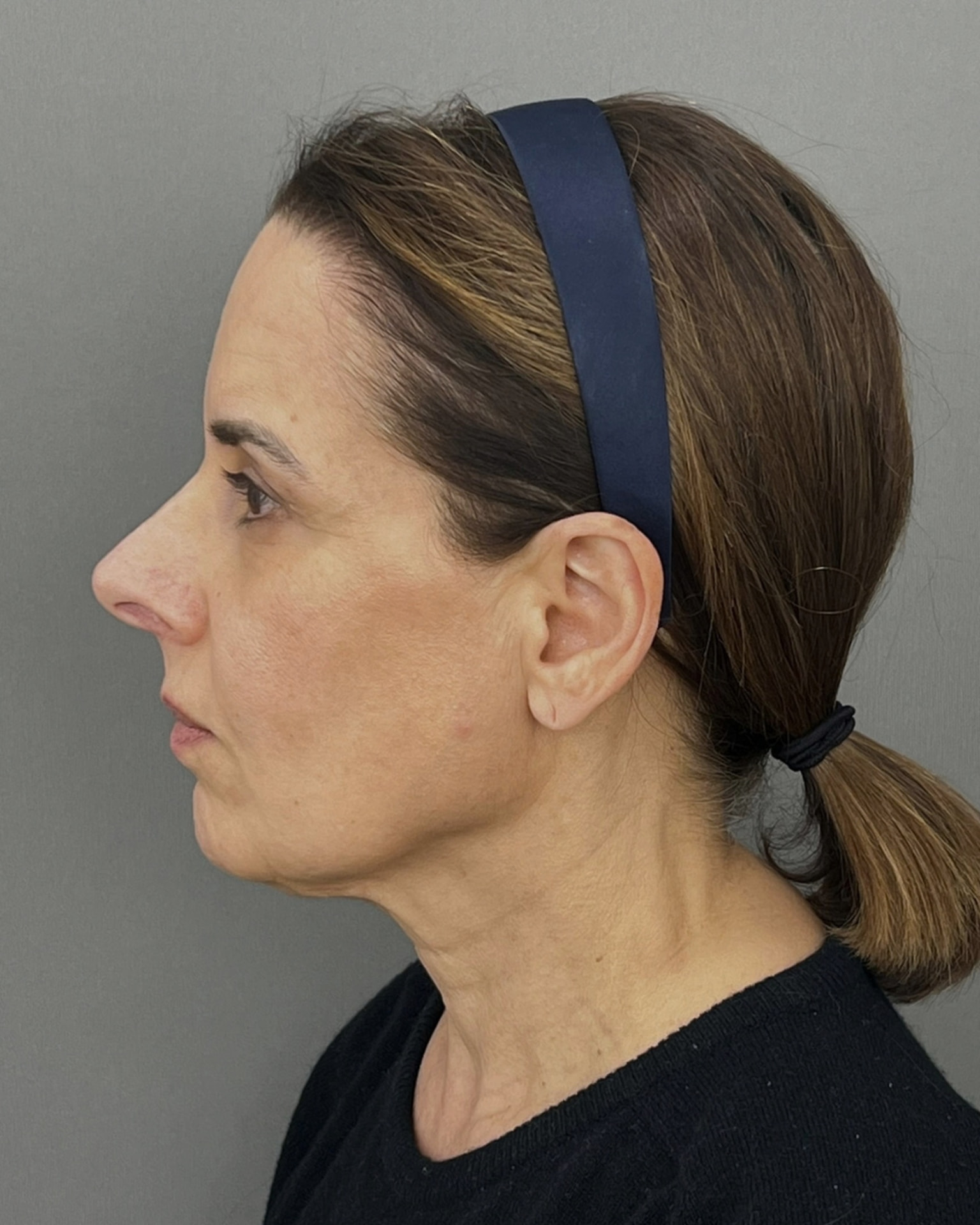 Deep Plane Facelift at 61: Upper, Mid & Lower Lift with Blepharoplasty — Before and After, before, view 3