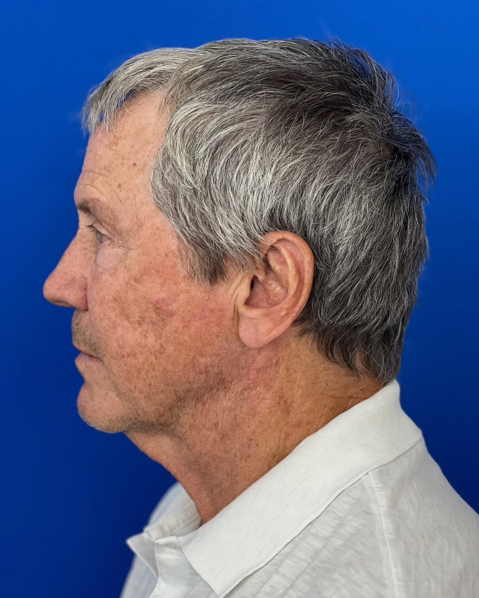 Worried About Keeping His Masculine Look: Natural Male Deep Plane Facelift, Neck Lift, Upper Blepharoplasty & CO₂ Laser Before and After at 72, before, view 3