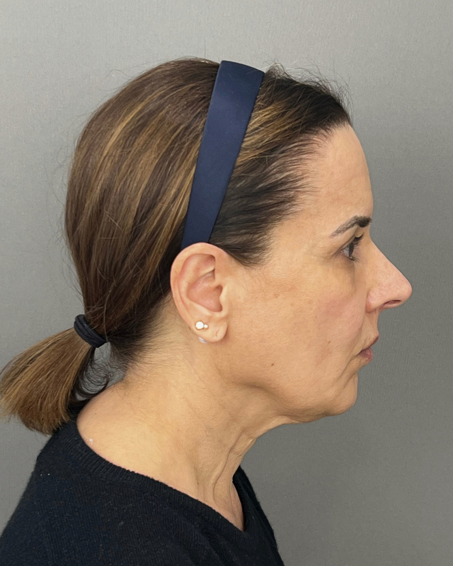 Deep Plane Facelift at 61: Upper, Mid & Lower Lift with Blepharoplasty — Before and After, before, view 5