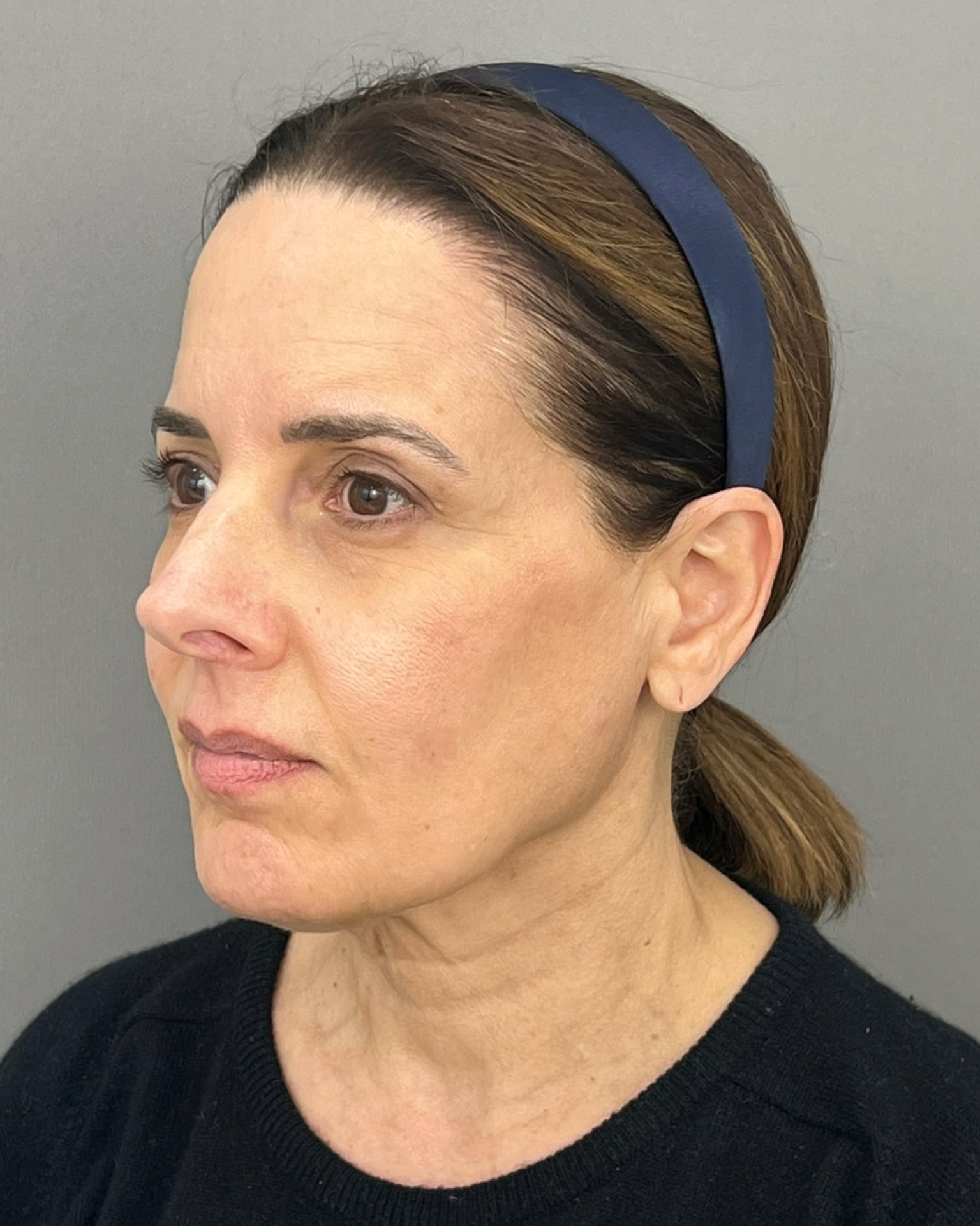 Deep Plane Facelift at 61: Upper, Mid & Lower Lift with Blepharoplasty — Before and After, before, view 2