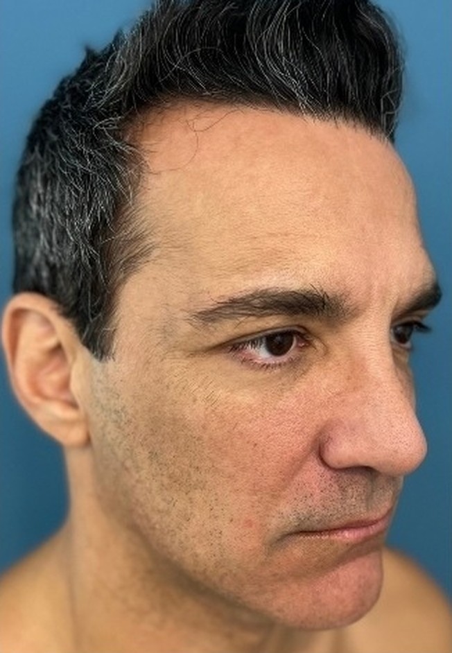 Sharper Jawline, Tighter Neck: Submental Platysmal Plication + Renuvion, Baseline neck and jawline prior to treatment, view 4
