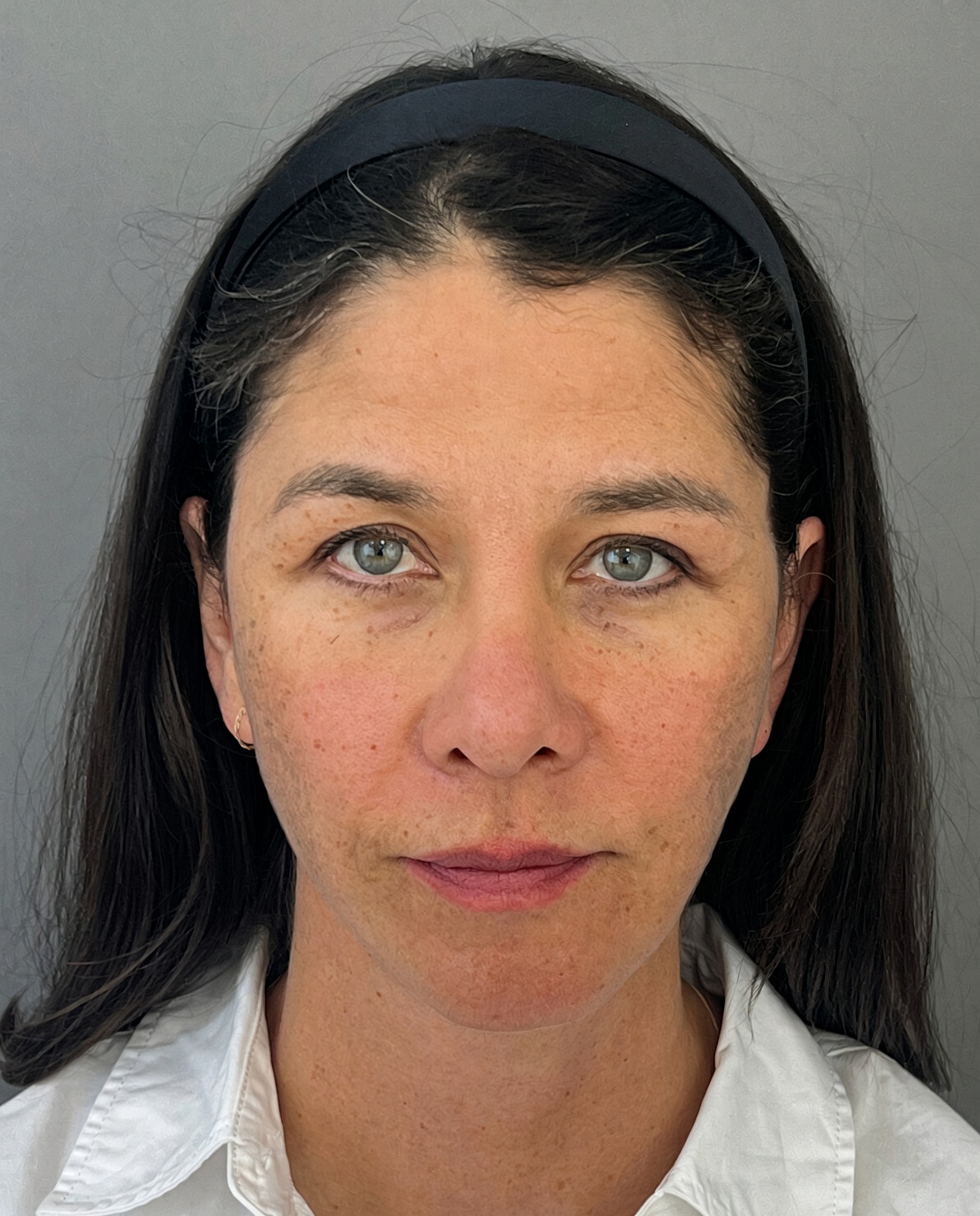 Bothered by Jowls and Nasolabial Folds, Concerned About Scars: Deep Plane Facelift Before and After at 55, after, view 1