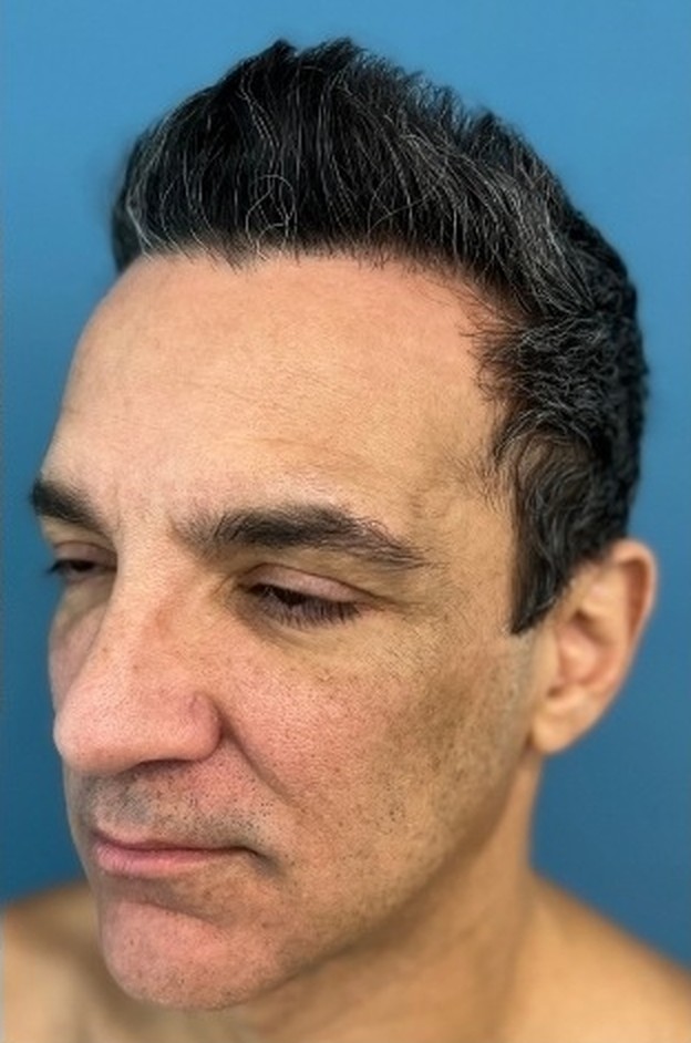 Sharper Jawline, Tighter Neck: Submental Platysmal Plication + Renuvion, Baseline neck and jawline prior to treatment, view 3
