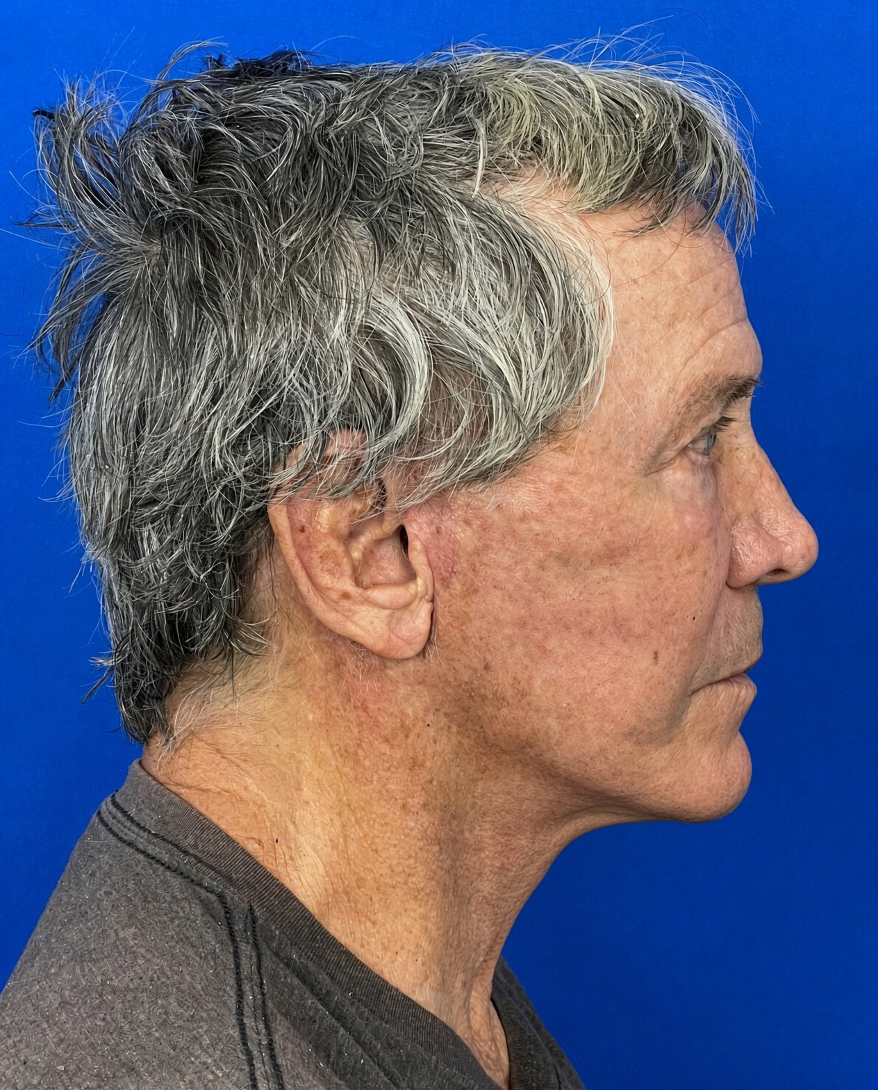 Worried About Keeping His Masculine Look: Natural Male Deep Plane Facelift, Neck Lift, Upper Blepharoplasty & CO₂ Laser Before and After at 72, after, view 5