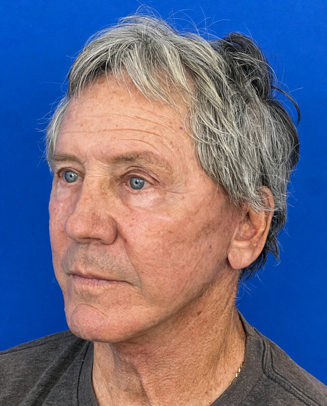 Worried About Keeping His Masculine Look: Natural Male Deep Plane Facelift, Neck Lift, Upper Blepharoplasty & CO₂ Laser Before and After at 72, after, view 2