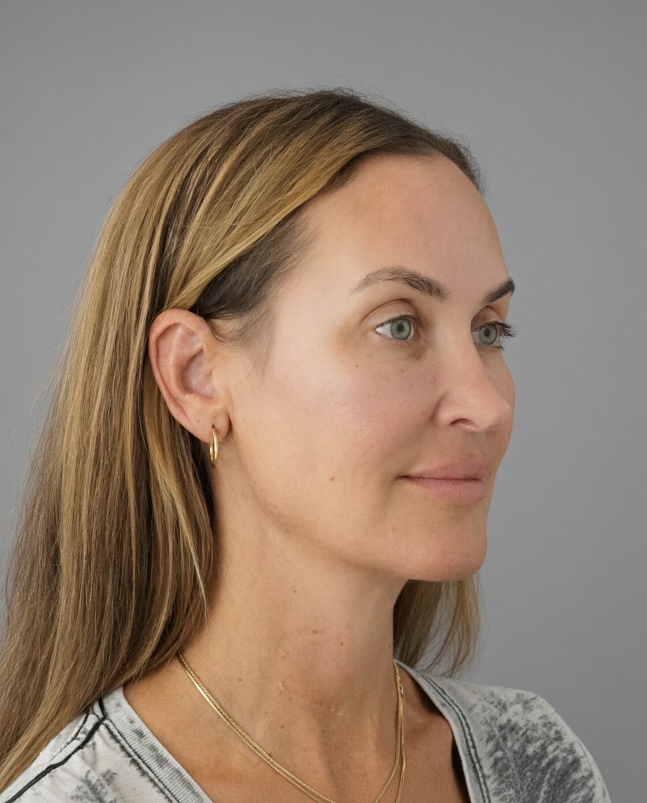 50 Year Old END of Aging Facelift by Dr. Suzanne Trott: Endoscopic Deep Plane Results at 3 Months, after, view 2