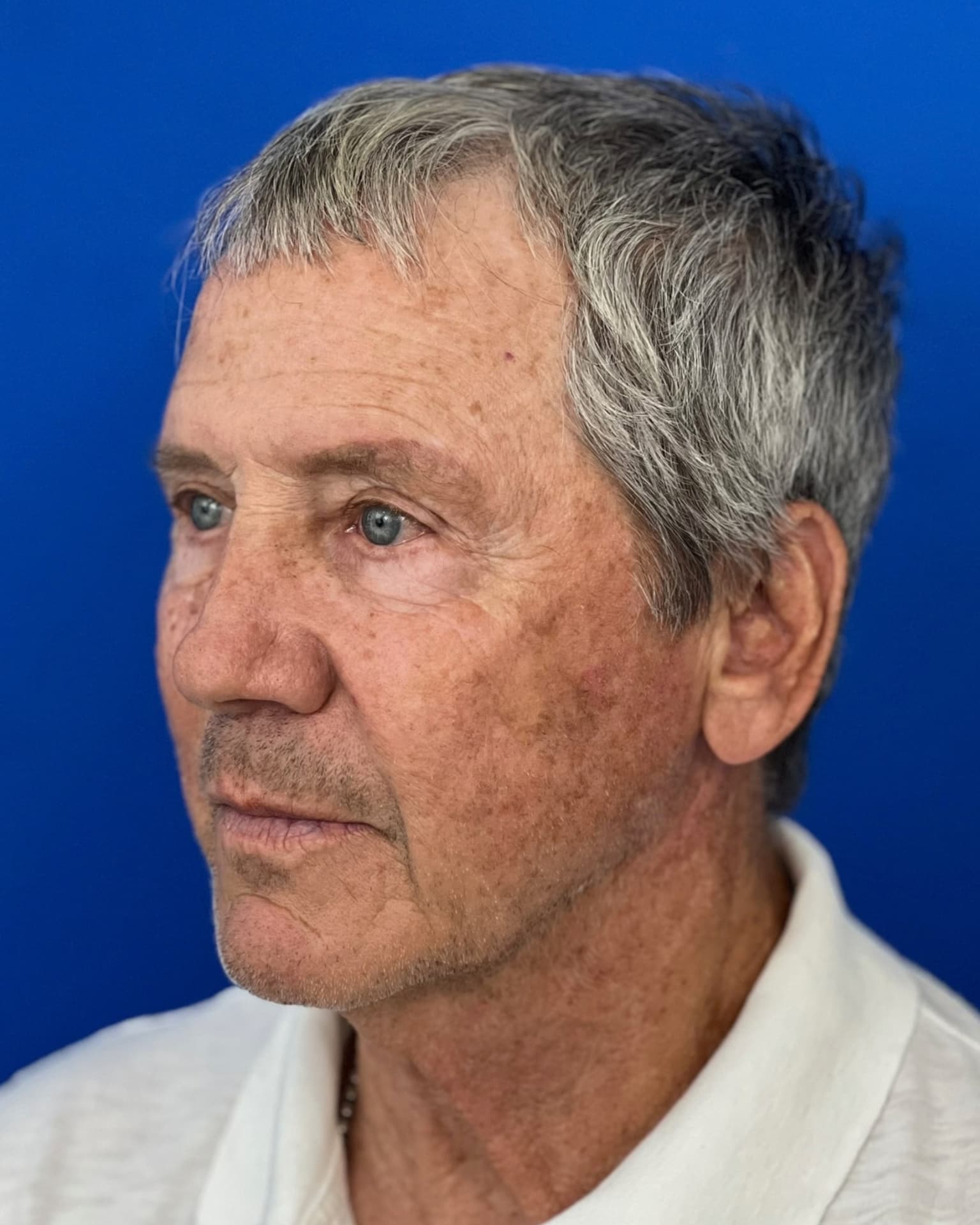 Worried About Keeping His Masculine Look: Natural Male Deep Plane Facelift, Neck Lift, Upper Blepharoplasty & CO₂ Laser Before and After at 72, before, view 2