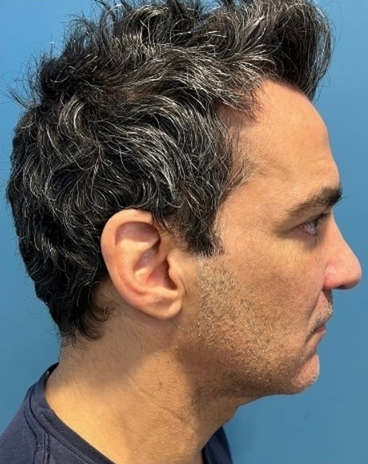 Sharper Jawline, Tighter Neck: Submental Platysmal Plication + Renuvion, Renuvion only — skin tightening without platysmal plication, view 5