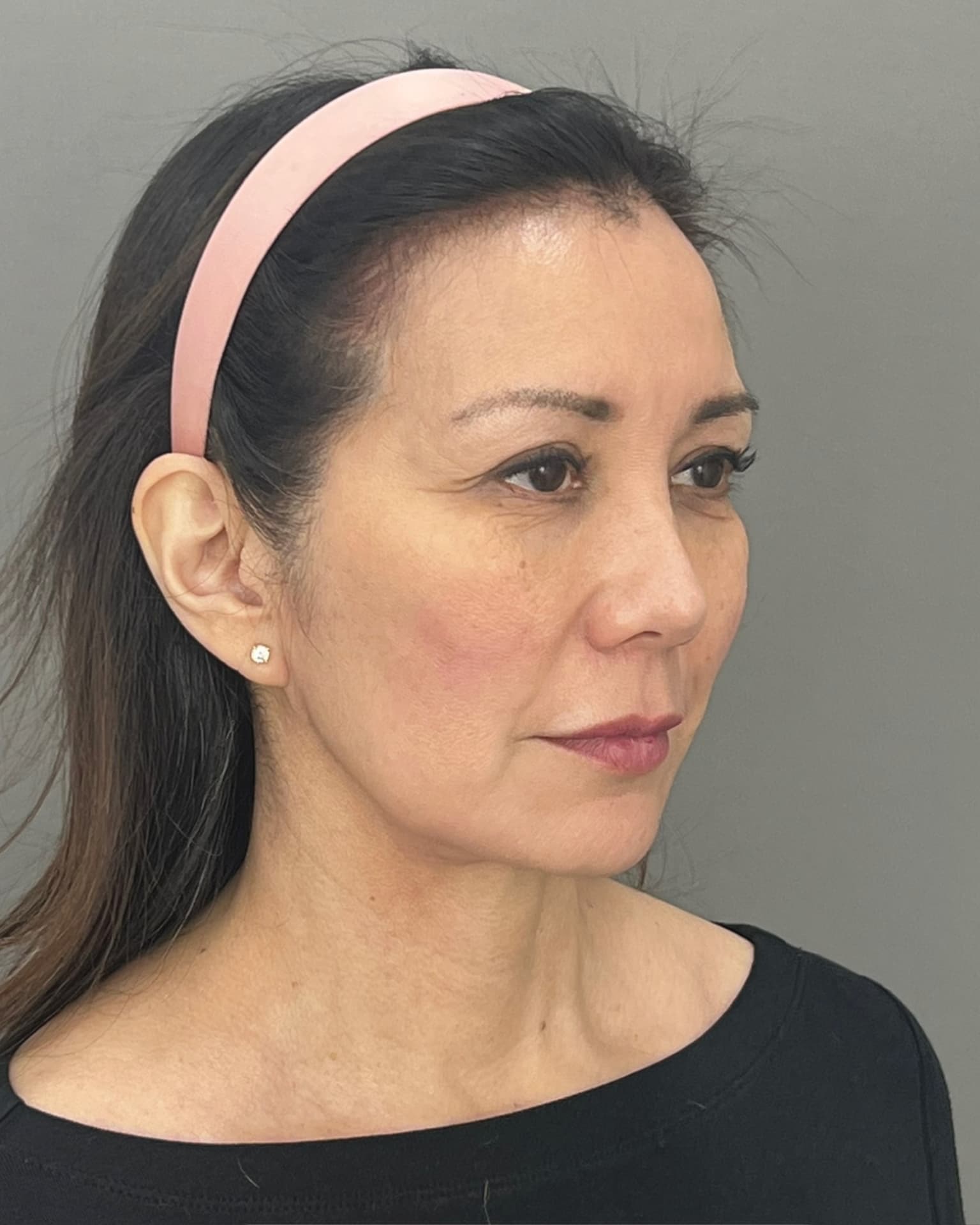 Facelift and Neck Lift at 60: Why Dr. Trott Started With the Neck, before, view 4