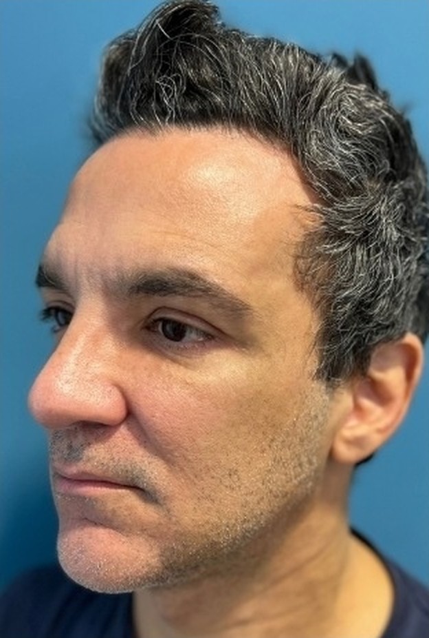 Sharper Jawline, Tighter Neck: Submental Platysmal Plication + Renuvion, Renuvion only — skin tightening without platysmal plication, view 3