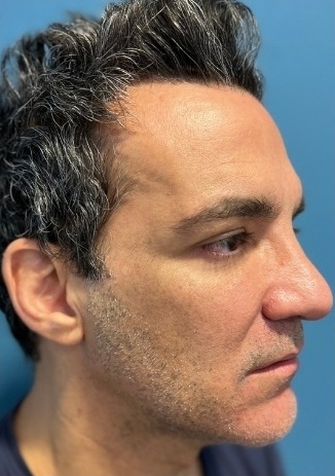 Sharper Jawline, Tighter Neck: Submental Platysmal Plication + Renuvion, Renuvion only — skin tightening without platysmal plication, view 4